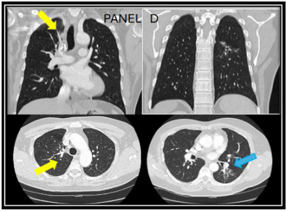 CT scans of the chest in a two-by-two panel layout. The top left image shows a vertical view of the lungs with a yellow arrow pointing to a particular area. The top right image displays another vertical lung view. The bottom left image has a cross-sectional view with a yellow arrow highlighting a spot. The bottom right image presents a cross-sectional view of the chest, with a blue arrow indicating a particular area.