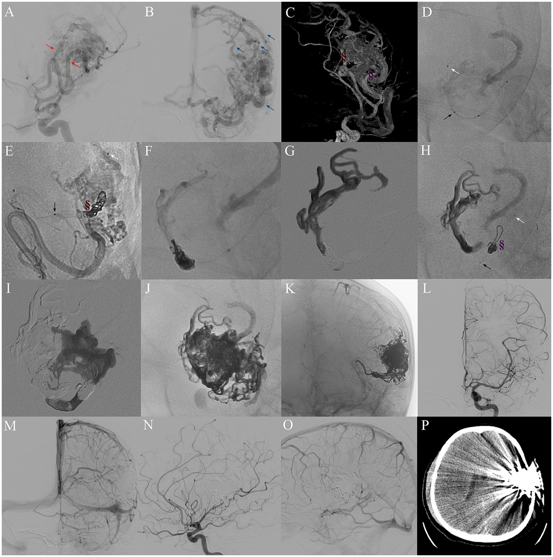 A grid of sixteen medical images showing angiographic views of cerebral blood vessels in varying orientations and techniques. Panels A to O display detailed vascular structures, some highlighted by arrows or annotations. Panel P shows a cross-sectional computed tomography scan, focusing on brain tissue. Each panel presents different visualizations, likely representing different cases or stages of a diagnostic process.