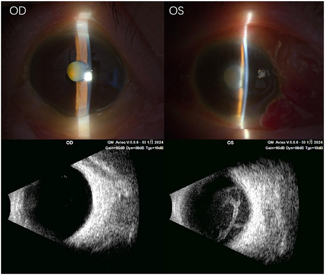 Upper section displays slit lamp photographs of two eyes labeled OD (right eye) and OS (left eye), highlighting the corneas. The lower section shows corresponding ultrasound images, depicting internal eye structures, with distinct patterns for each eye.