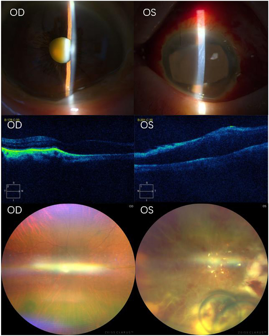 Four-panel image showing eye examinations. Top left: Slit lamp image of the right eye, showing a cataract. Top right: Left eye with apparent redness and opacities. Bottom left: OCT scan of the right eye displaying retinal layers. Bottom right: OCT scan of the left eye, indicating possible retinal swelling or detachment.