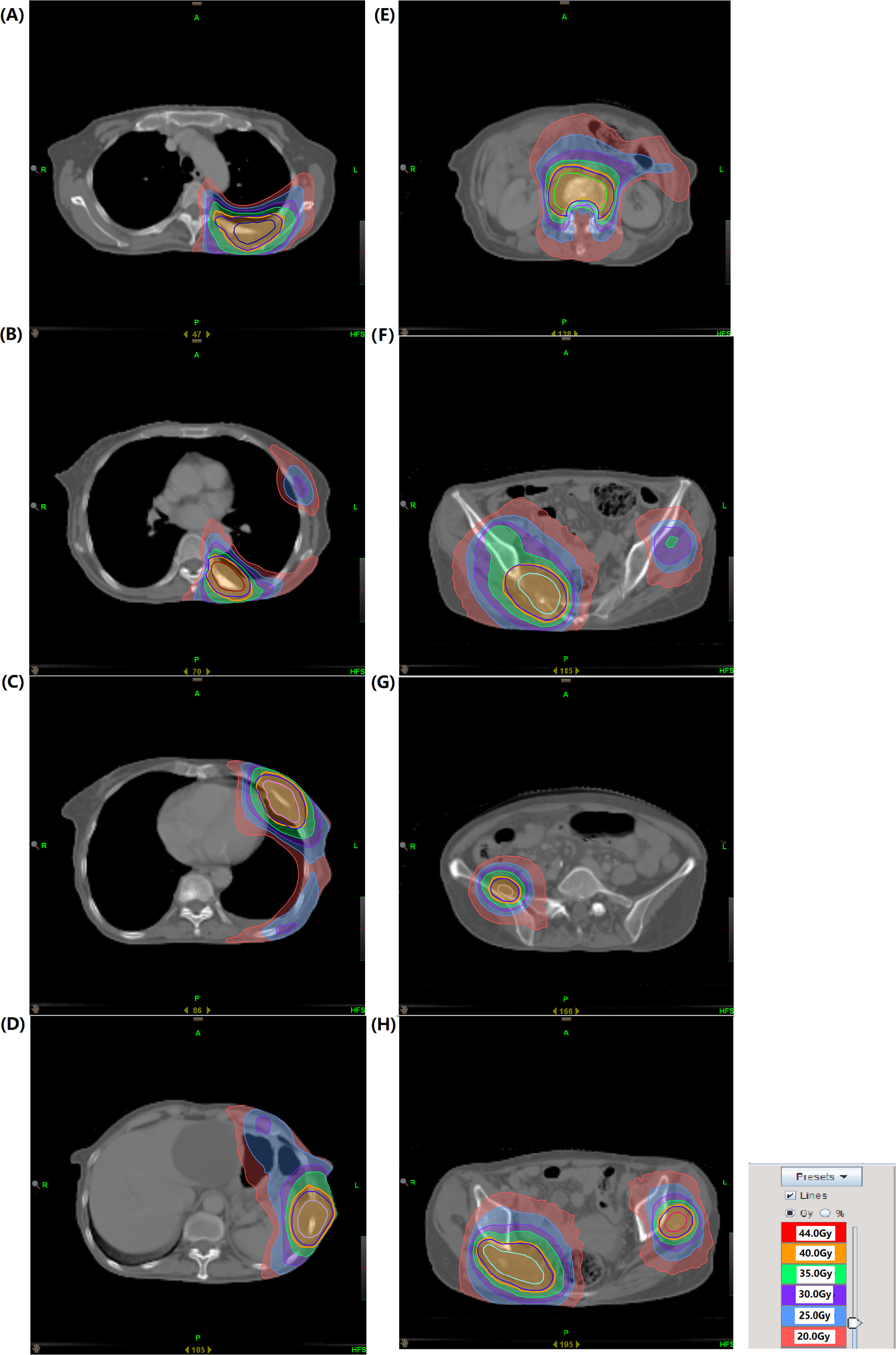 CT scan images labeled A to H display cross-sectional views ofthe thoracic and pelvic regions with colored contour lines indicating radiationdosage levels, ranging from 20 to 44 gray. Each panel demonstrates how these dosagesare distributed, with the right side of each image showing a color legend.