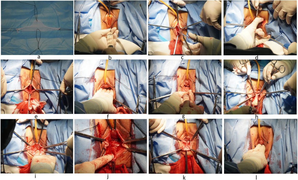 Panel a shows a synthetic mesh implant with four sutures positioned on a sterile field. Panels b to l depict sequential surgical steps of transvaginal mesh placement for pelvic organ prolapse repair. Panel b shows the initial perineal incision with catheter in place, followed by tissue dissection and exposure of anatomical structures in panels c through f. Panel g shows further mobilization and dissection, with mesh insertion and fixation occurring in panels h through k. Panel l demonstrates final positioning and closure of the surgical site.
