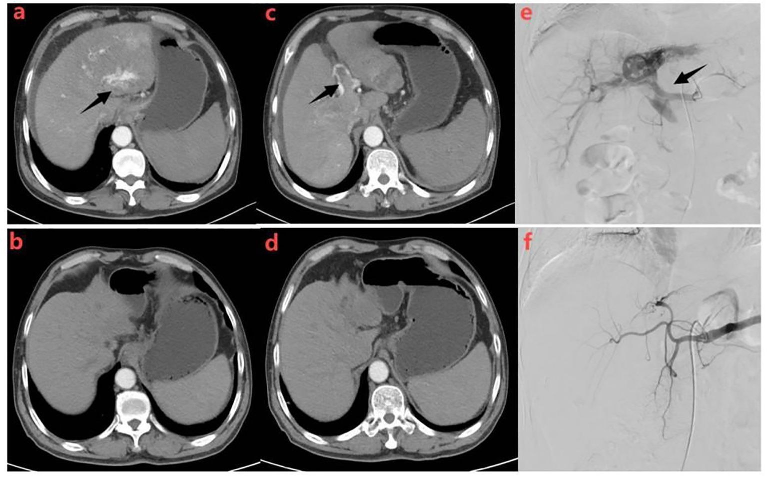 Six-panel medical imaging series showing liver scans. Panels a and b display a liver lesion highlighted by arrows on CT images. Panels c and d show a post-procedure image with reduced lesion visibility. Panels e and f are angiographic images, with panel e highlighting a vascular structure. Overall, the series demonstrates lesion changes pre- and post-treatment.