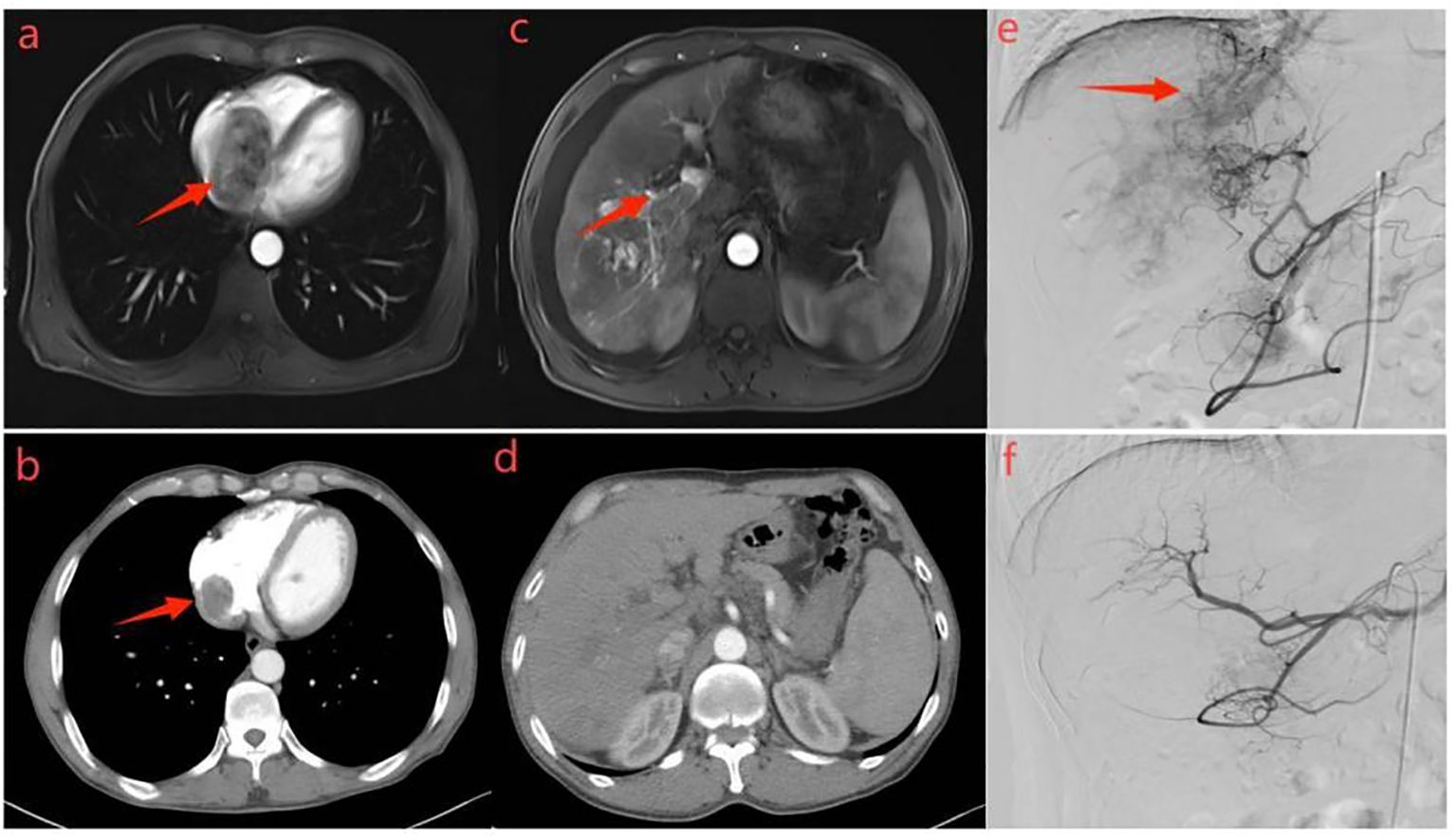 Six-panel medical imaging series with arrows indicating areas of interest. Panels a and b show cross-sectional chest MRIs with marked regions. Panels c and d depict abdominal MRIs with highlighted areas. Panels e and f display angiograms demonstrating vascular structures with highlighted sections.