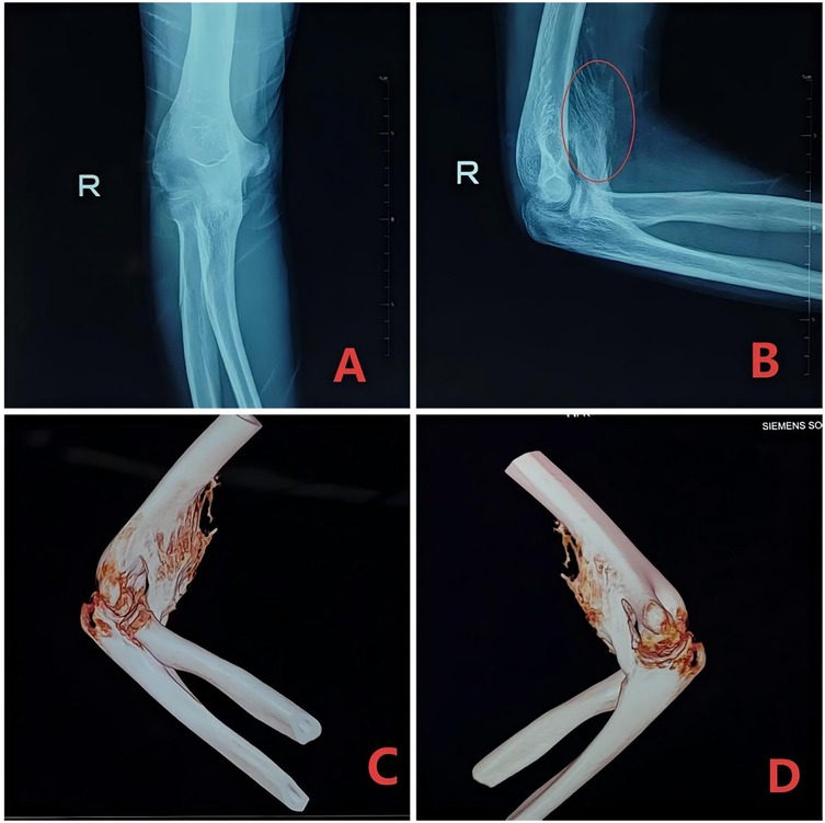 X-ray and 3D images of a right elbow are shown. Image A displays a frontal X-ray, and B a side view with an area circled. Image C and D are 3D reconstructions showing different angles of the elbow’s bone structure, highlighting damage or irregularity at the joint.