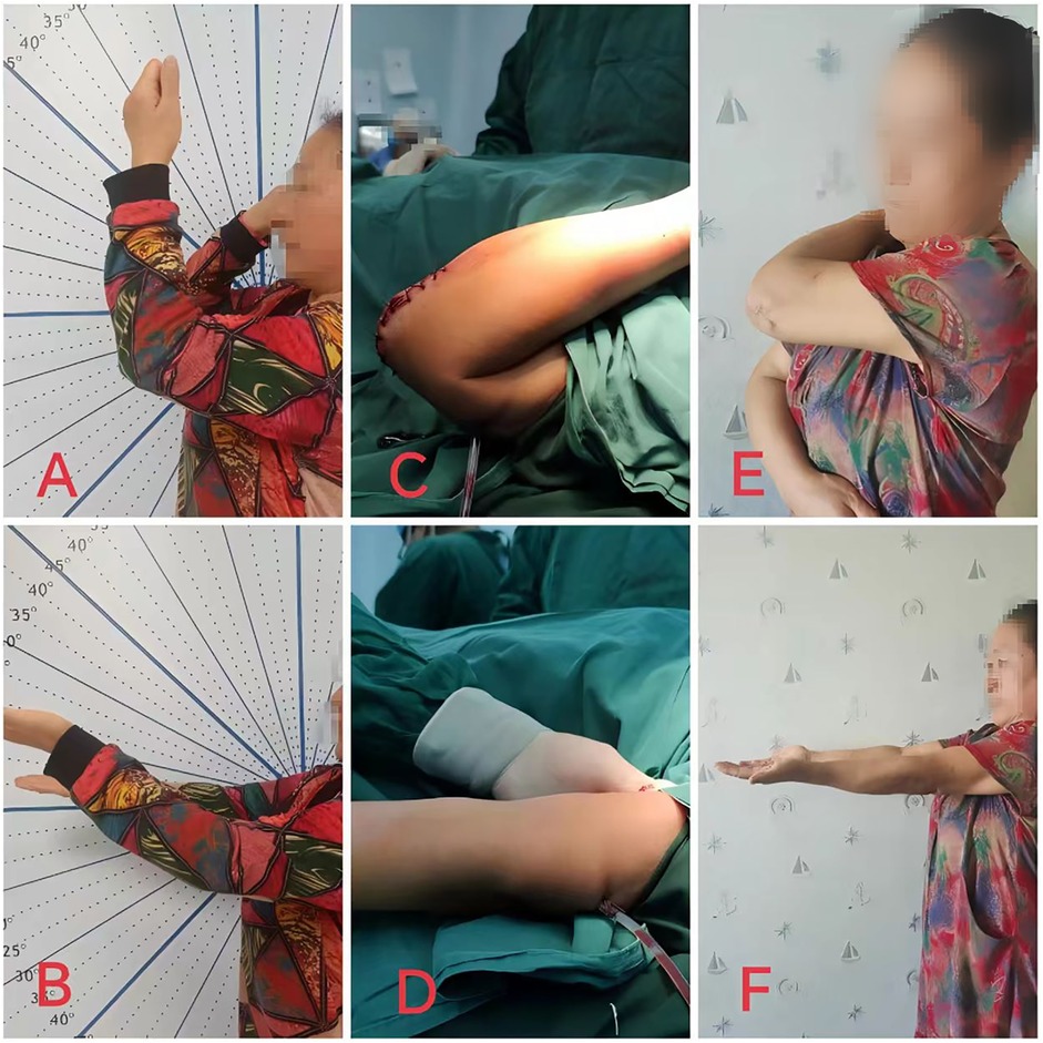 Six-panel image showing stages and results of a surgical procedure on an arm. Panels A and B display measured arm angles against a scale. Panels C and D show the arm during surgery, with visible incisions. Panels E and F depict the arm post-recovery, demonstrating range of motion in different arm positions.