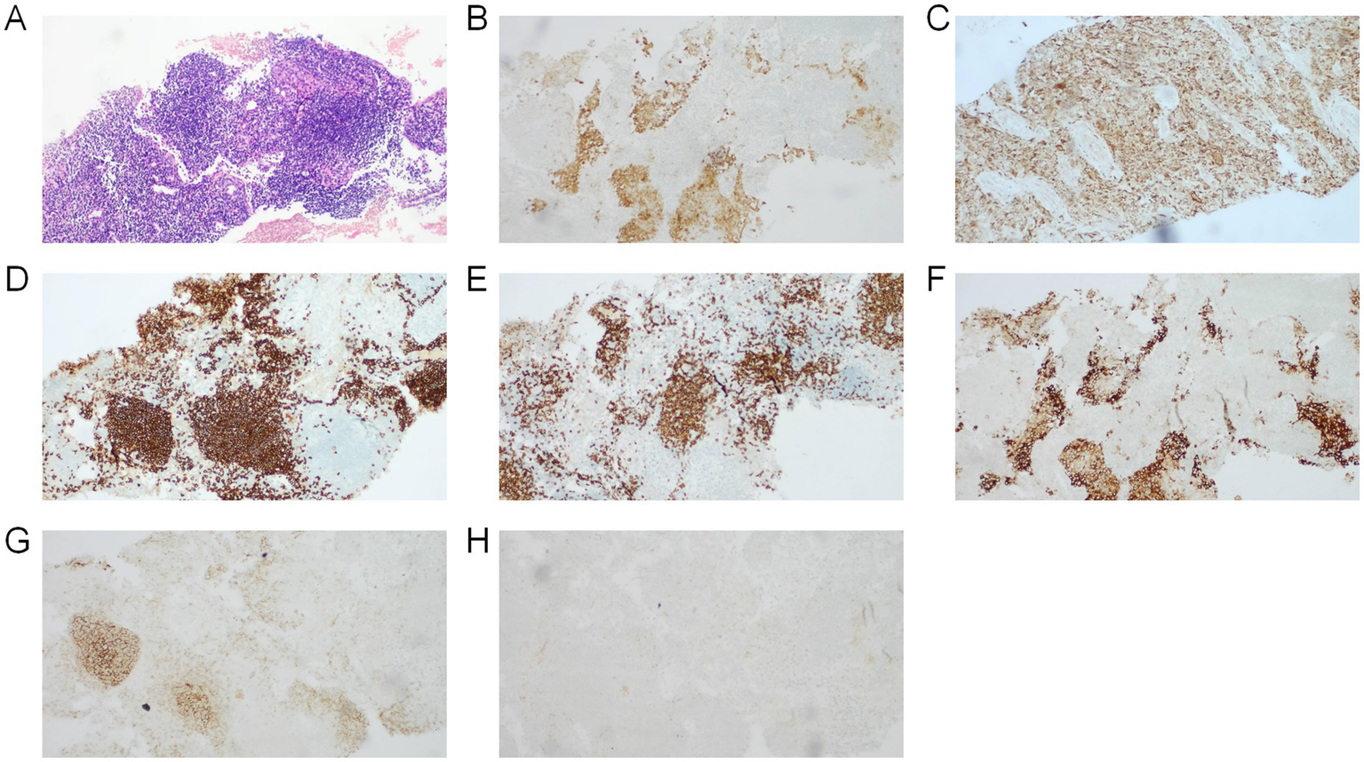 Collection of eight histological images labeled A to H. Image A shows tissue stained with hematoxylin and eosin, presenting dense aggregation of cells. Images B to H show varying degrees of brown immunohistochemical staining. Each image highlights different patterns and intensities of staining, indicating varying levels of specific protein expression or activity within the tissues.