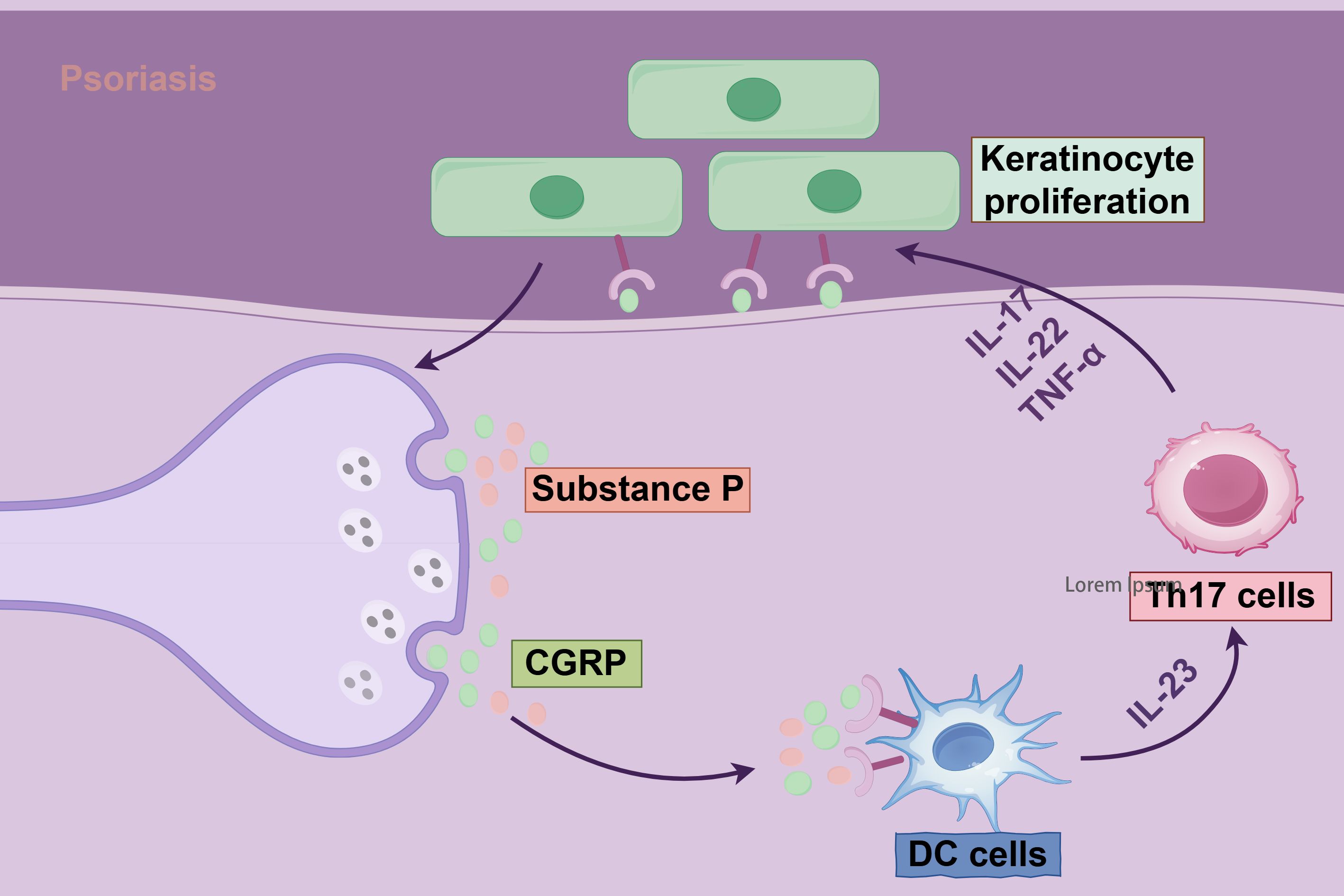 Illustration explaining psoriasis mechanisms. Nerve endings release Substance P and CGRP, interacting with DC cells. DC cells release IL-23, influencing Th17 cells. Th17 cells produce IL-17, IL-22, and TNF-alpha, leading to keratinocyte proliferation. Arrows indicate the direction of interaction.