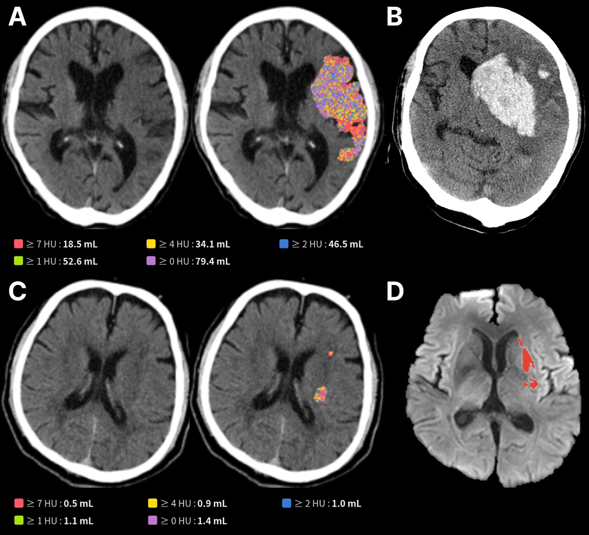 Four brain images labeled A, B, C, and D. Image A shows a non-contrast CT with a large automatically indentified infarct core of (79.4 mL), color-coded by Hounsfield unit thresholds. Image B shows follow-up CT of the case from Image A with parenchymal hematoma type II hemorrhagic transformation. Image C shows a case with a small automatically identified infarct core (1.4 mL). Image D shows delayed MRI without hemorrhagic transformation, which is from the case from Image C.