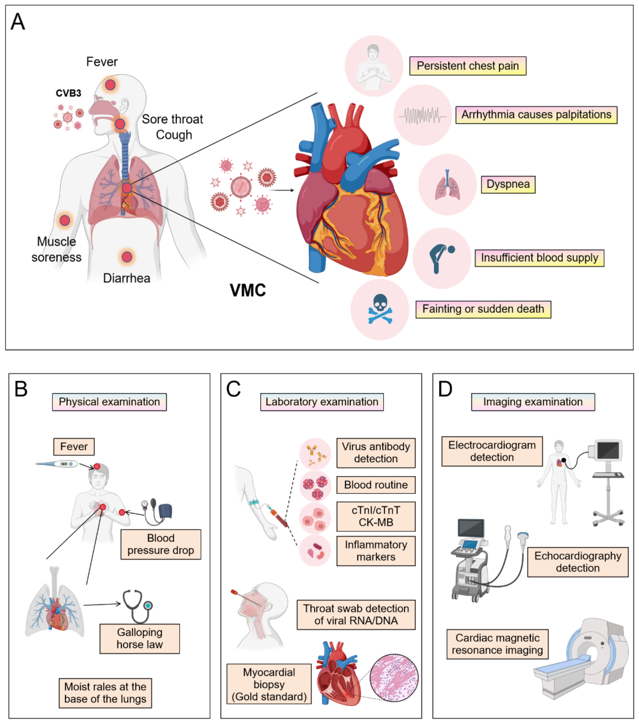 Illustration detailing viral myocarditis (VMC) diagnosis. Panel A shows symptoms: fever, sore throat, cough, muscle soreness, diarrhea, persistent chest pain, arrhythmia, dyspnea, insufficient blood supply, fainting, or sudden death. Panel B outlines physical examinations: fever check, blood pressure drop, lung sounds. Panel C covers laboratory examinations: virus antibody detection, blood routine, specific cardiac markers, inflammatory markers, throat swab, and myocardial biopsy. Panel D describes imaging examinations: electrocardiogram, echocardiography, and cardiac MRI. Each component is visually represented with relevant icons and diagrams.