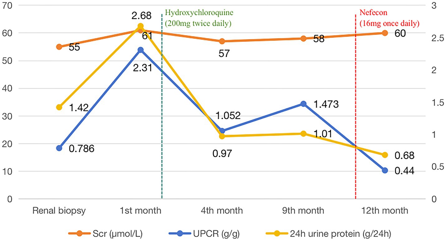Line graph showing Scr, UPCR and 24-hour urine protein levels over time from renal biopsy to 12 months. Scr remains relatively stable. Urine protein peaks at the first month, decreases by the fourth month after the treatment with Hydroxychloroquine, then stabilizes. After Nefecon treatment, the urine protein level significantly decreased.
