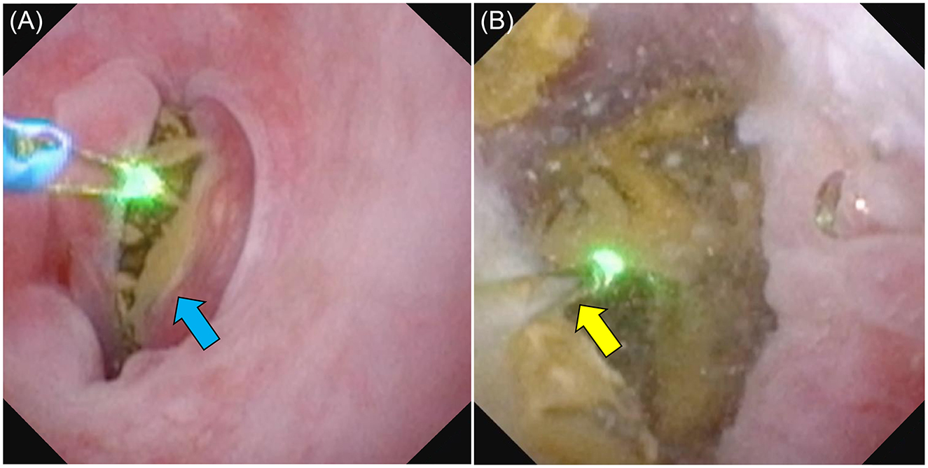 Two-panel endoscopic images showing laser treatment for laryngeal lesions. Panel A shows a close-up of the larynx with a blue arrow pointing to a tissue area illuminated by a green laser. Panel B shows another view of the larynx with a yellow arrow highlighting another illuminated area by the laser.
