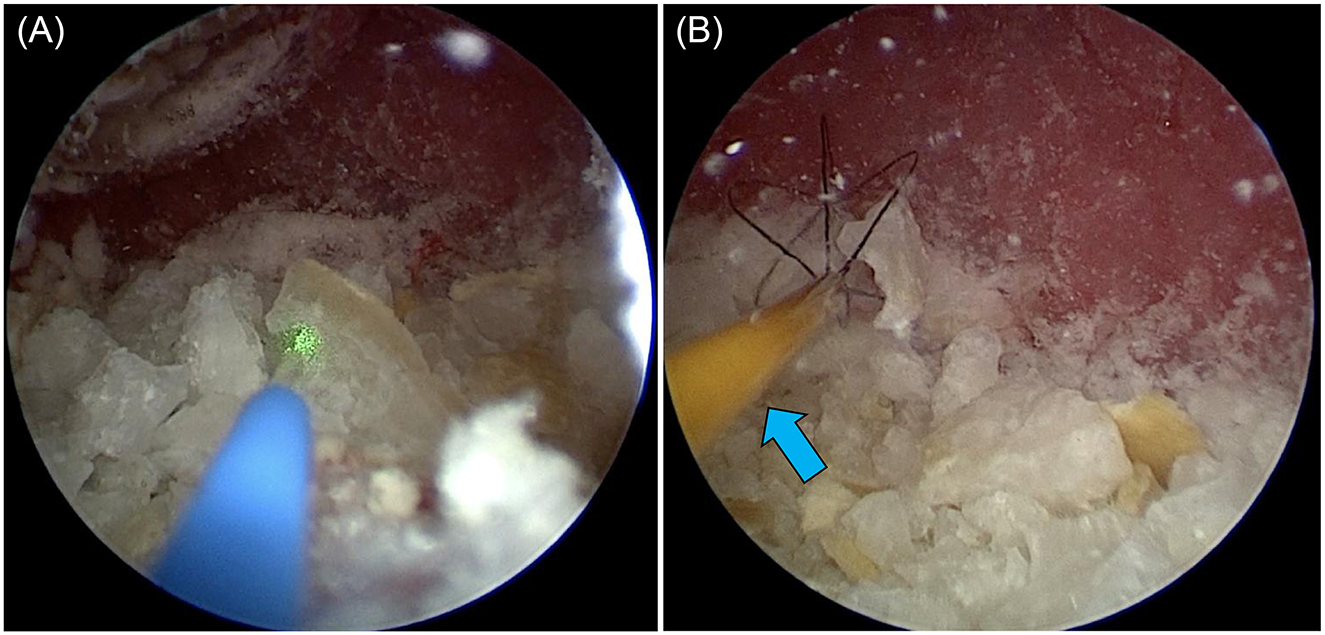 Two medical endoscopic images labeled A and B. Image A shows a close-up of tissue with a blue instrument and a small green illuminated area. Image B shows the same tissue with a different tool and a blue arrow pointing to the instrument, indicating an area of focus.