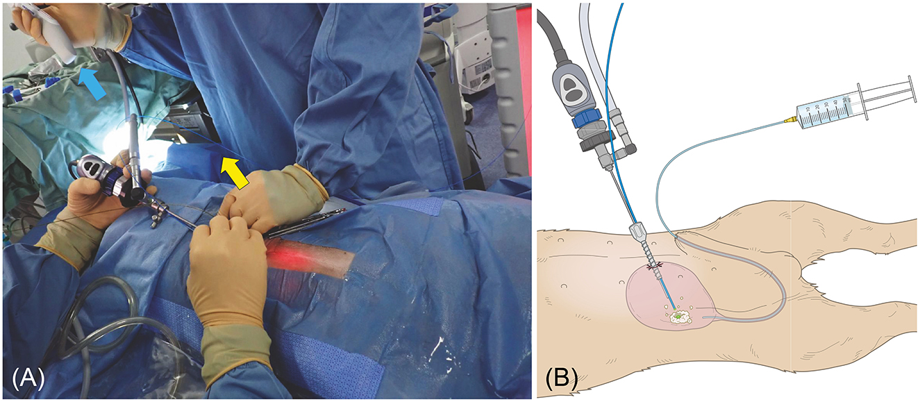 Panel A shows surgeons in blue gowns performing a laparoscopic procedure. One holds a camera while another uses an instrument on the patient's abdomen. Panel B is an illustration depicting a close-up of instruments inserted into a patient's body, connected to a syringe, showing the medical procedure.