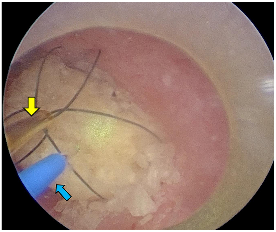 Endoscopic view showing a surgical instrument with a yellow arrow pointing to it, grasping a stone inside a cavity. A blue arrow indicates another part of the tool, highlighting the medical procedure. The surrounding tissue appears pink.