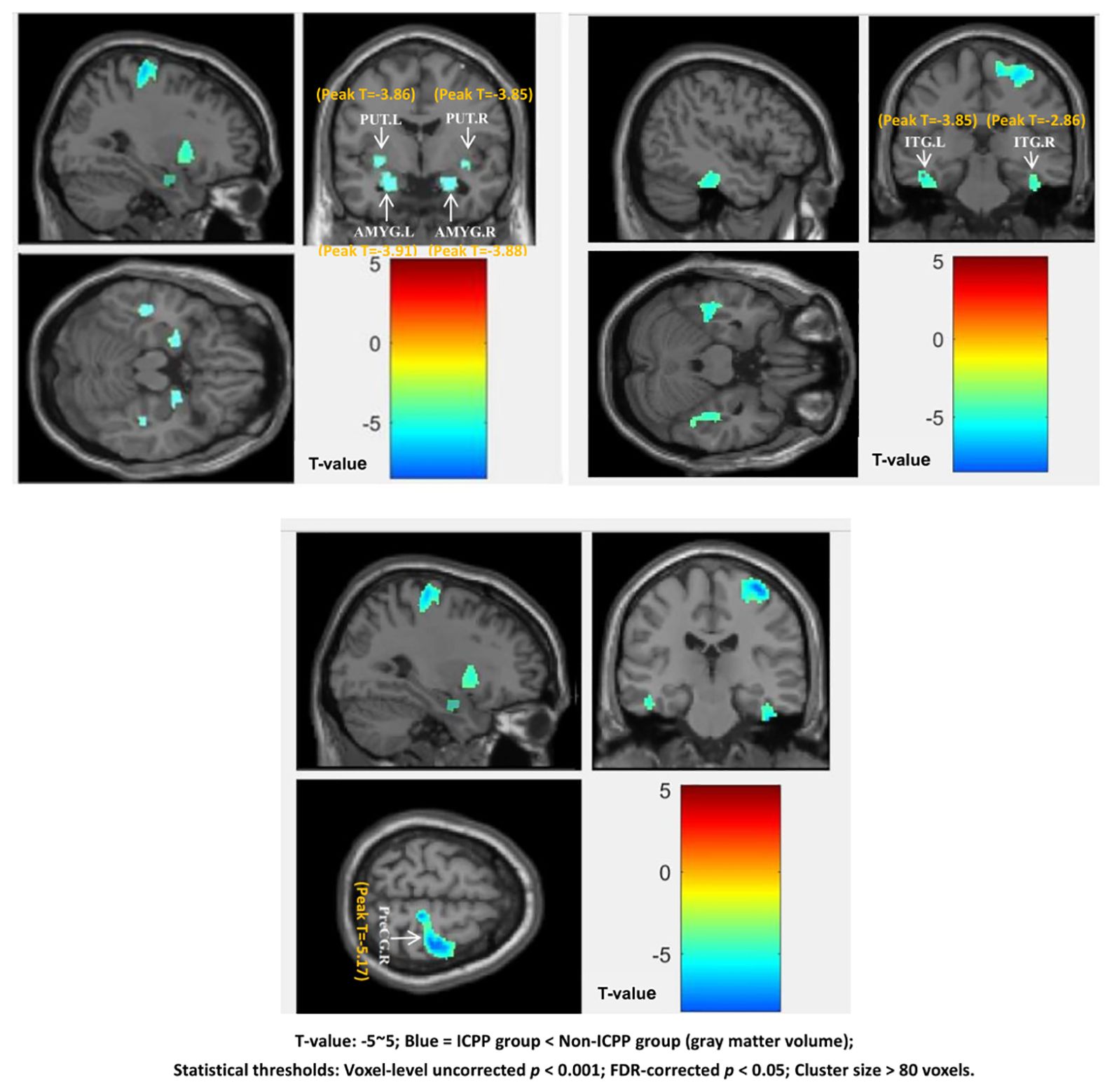 MRI scans displaying brain activity differences between groups. Highlighted in blue are regions where the ICPP group has less gray matter volume than the Non-ICPP group, including areas labeled AMYG and ITG. The T-value color scale ranges from negative five to five, with statistical thresholds noted for significance.