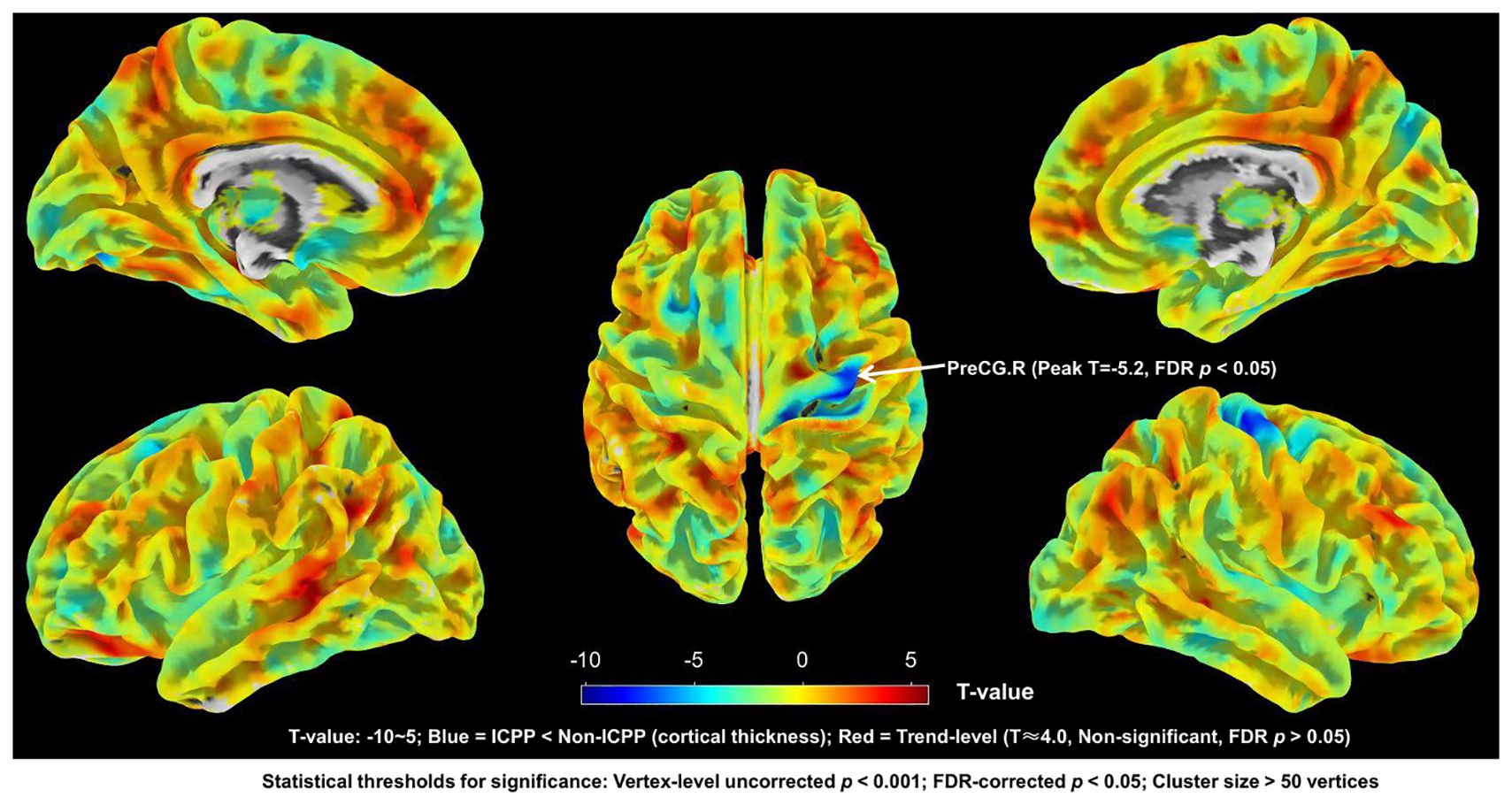 Cross-sectional brain images color-coded to indicate T-values of cortical thickness differences. Blue shows lower thickness in ICPP compared to non-ICPP; red indicates non-significant trends. A color scale from -10 to 5 is displayed, with a marked PreCG.R region indicating significant differences. Statistical thresholds are noted below.