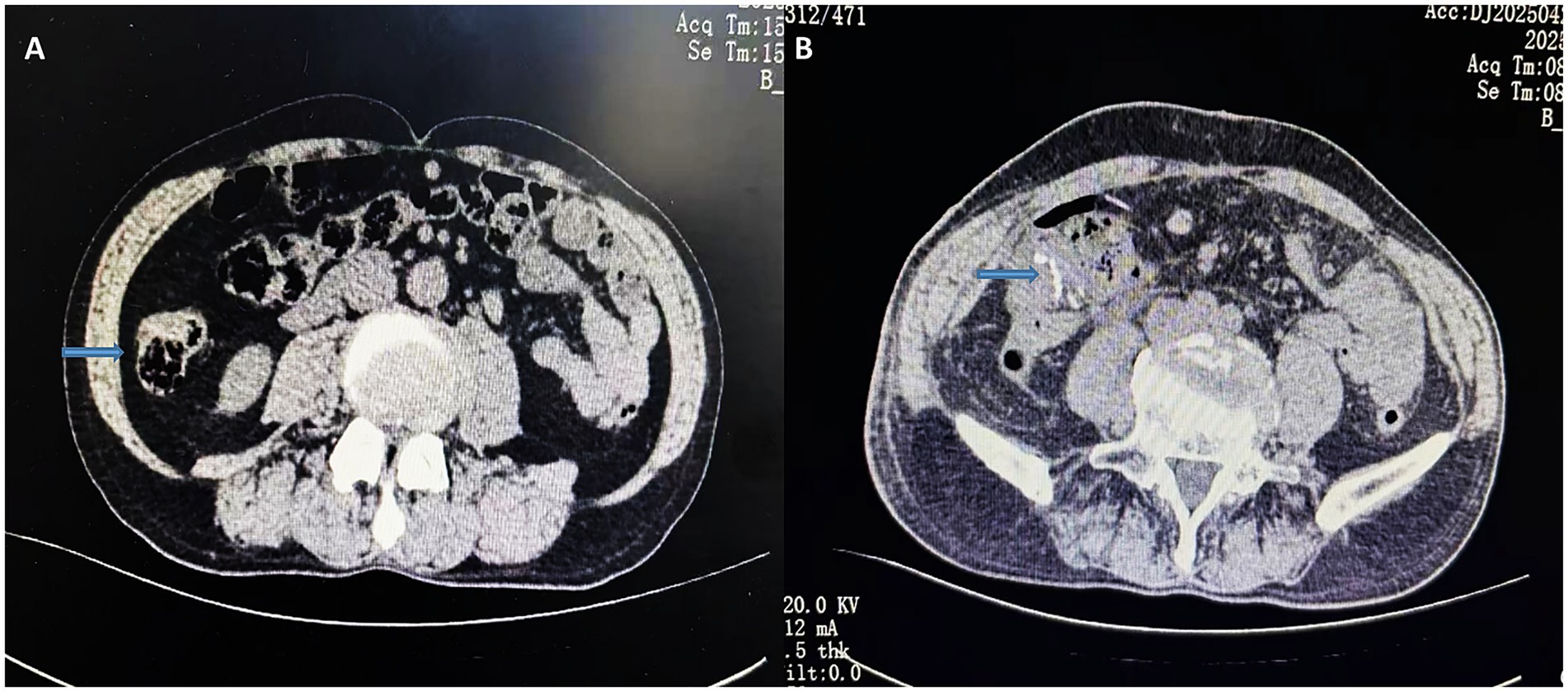 CT scan with two images labeled A and B showing axial abdominal views. Image A highlights a region on the left side with a blue arrow pointing to a specific area. Image B, on the right, shows another section with a blue arrow indicating a different point of interest. Both scans display abdominal organs and structures in cross-section.