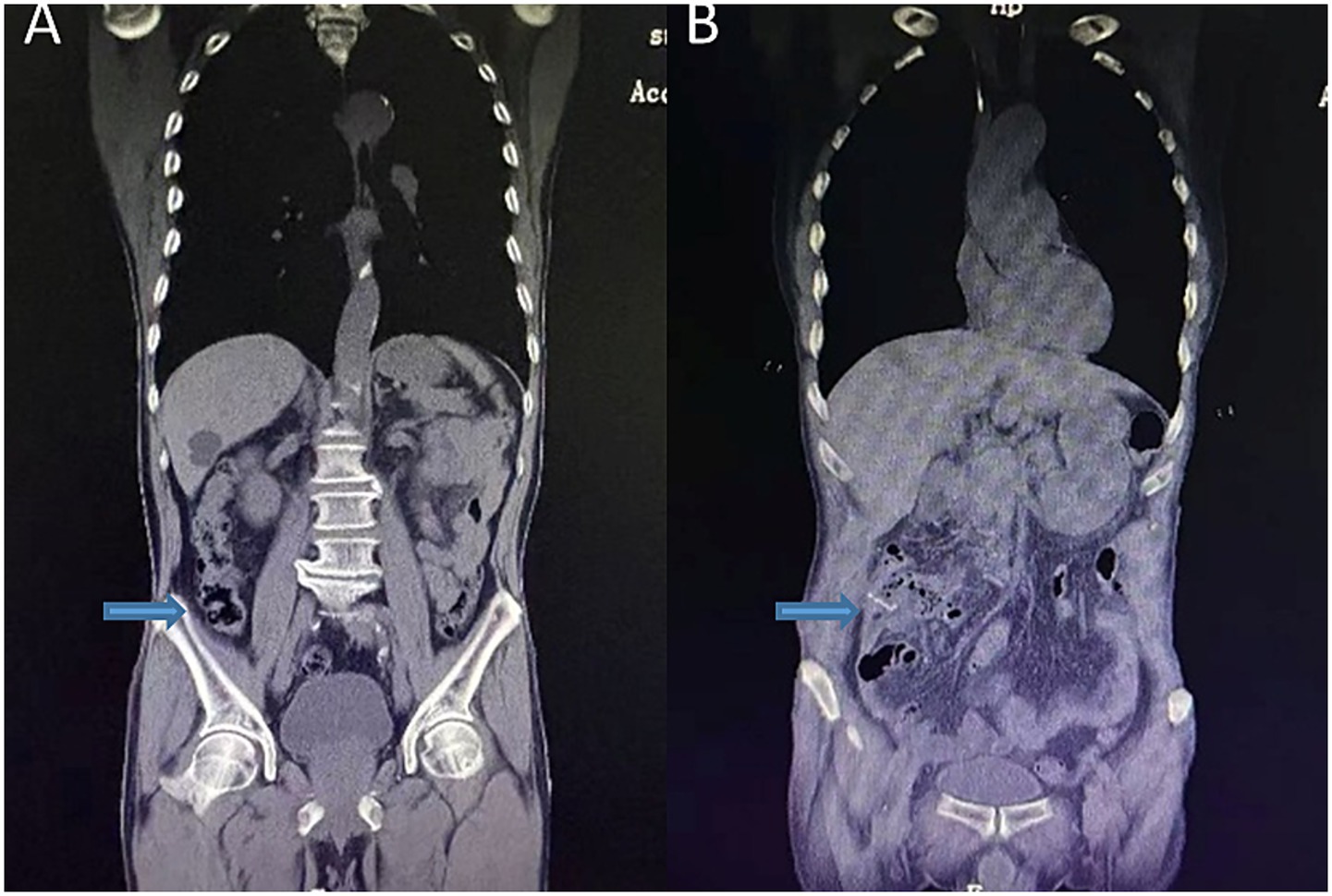 CT scan images labeled A and B showing cross-sectional views of the abdomen. Image A displays organs, bones, and soft tissues clearly, with a blue arrow pointing to a specific area. Image B shows similar anatomical structures with different shading and another blue arrow highlighting a region.