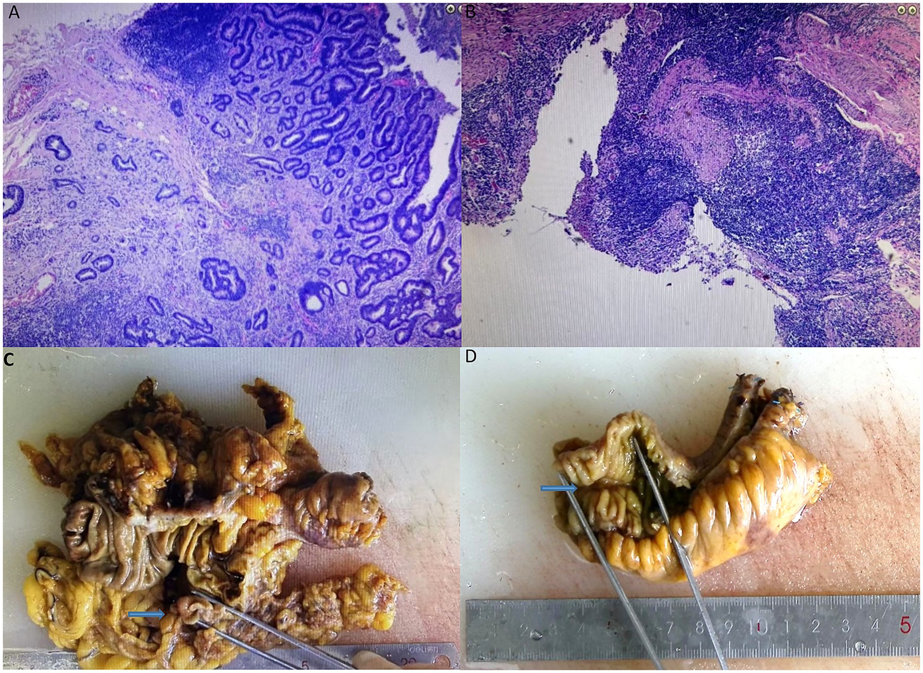 Microscopic images in panels A and B show tissue samples with varying degrees of cellular architecture stained in purple and pink. Panel C shows a dissected intestinal segment with a probe pointing at a specific area; the tissue has a wrinkled, yellow-brown appearance. Panel D features a section of the intestine on a ruler, again with a probe pointing to it, exhibiting a similar yellow-brown texture.