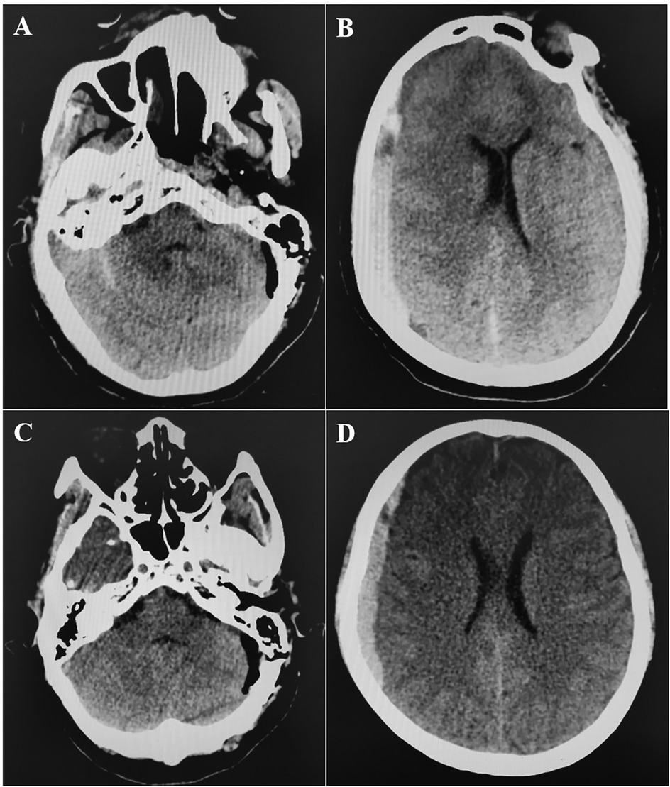 Four-panel image of CT brain scans labeled A, B, C, and D. Panel A shows a transverse section with sinus involvement. Panel B shows a cross-section with brain matter visible. Panel C displays another transverse section highlighting cranial structures. Panel D shows a cross-section focusing on the brain's central area.