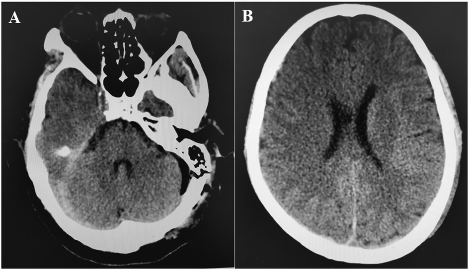 CT scan showing two different brain images. Image A displays a horizontal cross-section of the brain, highlighting asymmetrical features. Image B presents a more symmetrical brain structure with clear differentiation between the gray and white matter.