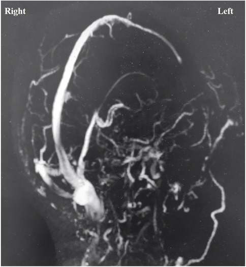 MRI scan showing cerebral blood vessels with a focus on the right side. Vessels are highlighted against a darker background, indicating the flow of blood in the brain.