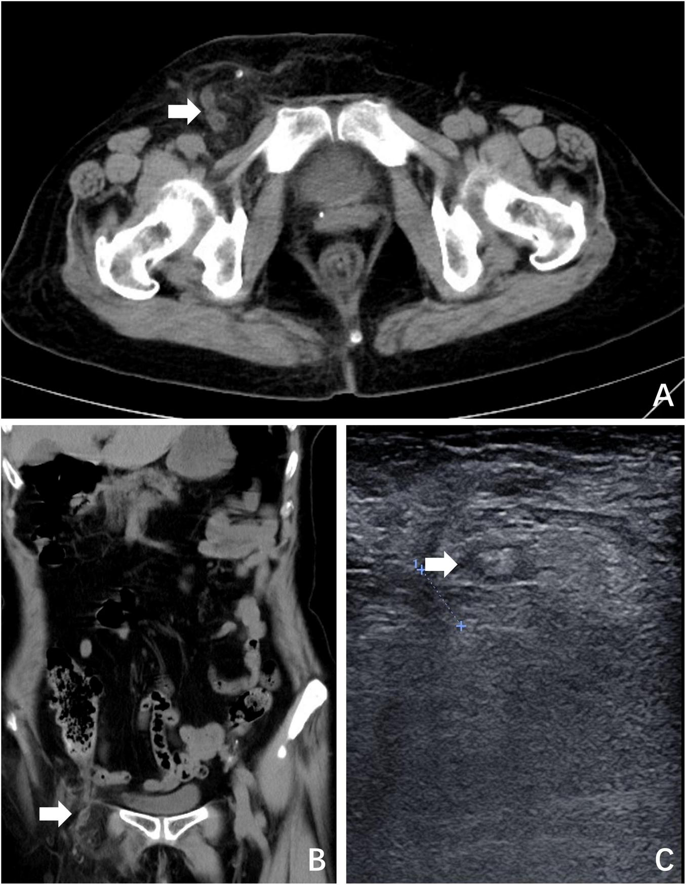 Medical imaging consisting of three panels labeled A, B, and C. Panel A shows a horizontal CT scan with an arrow indicating an area of interest near the pelvic region. Panel B displays a vertical CT scan with another arrow pointing to a specific area in the abdominal region. Panel C presents an ultrasound image with an arrow highlighting a particular spot. Each arrow is used to draw attention to significant areas for diagnostic purposes.