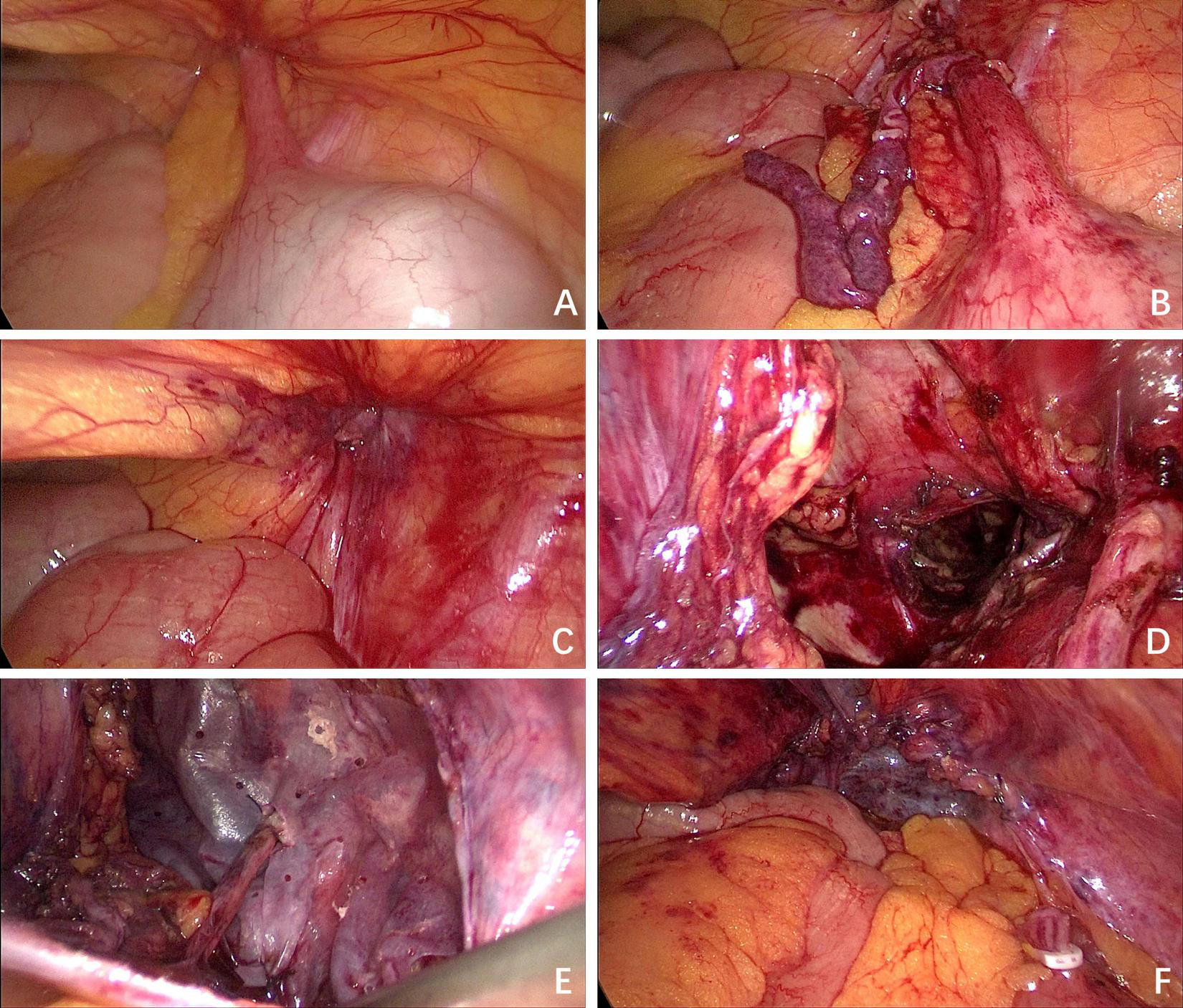 Six laparoscopic images labeled A to F show various stages of an abdominal procedure. A displays an initial view with minimal intrusion. B and C show increased exposure, revealing organs and vascular structures. D, E, and F depict further dissection, with organ manipulation and the presence of adipose tissue, possibly showcasing surgical progress or complications.