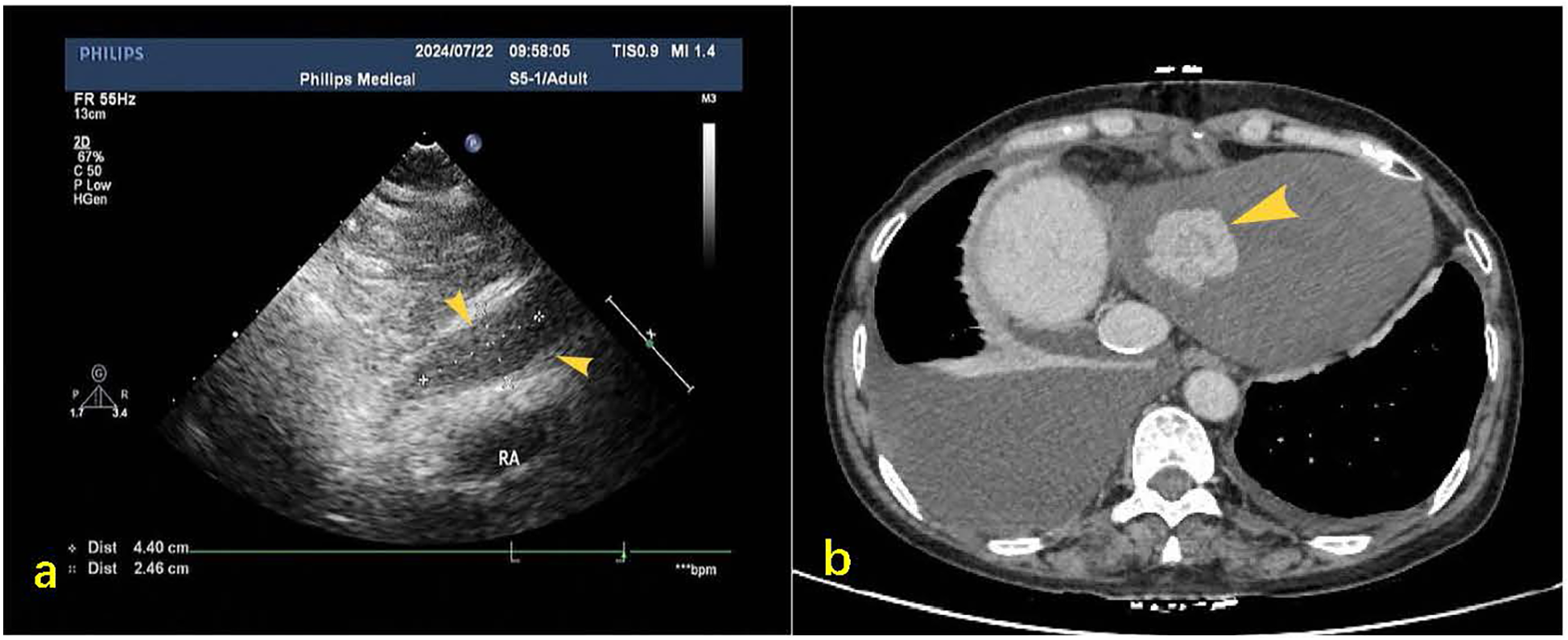 Split image showing two medical scans. On the left (a), an ultrasound image shows highlighted areas within a heart region marked as \“RA\” with yellow arrows. On the right (b), a CT scan illustrates a cross-section of the heart, with a highlighted area on the right atrium marked by a yellow arrow.