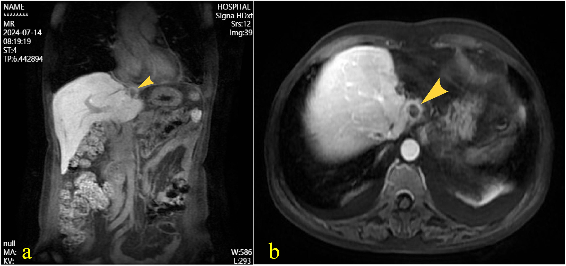 MRI images showing two views of the abdomen. Image (a) is a sagittal view with a yellow arrowhead indicating an area near the liver. Image (b) is an axial view highlighting the same area with a yellow arrowhead, suggesting a point of interest or abnormality.