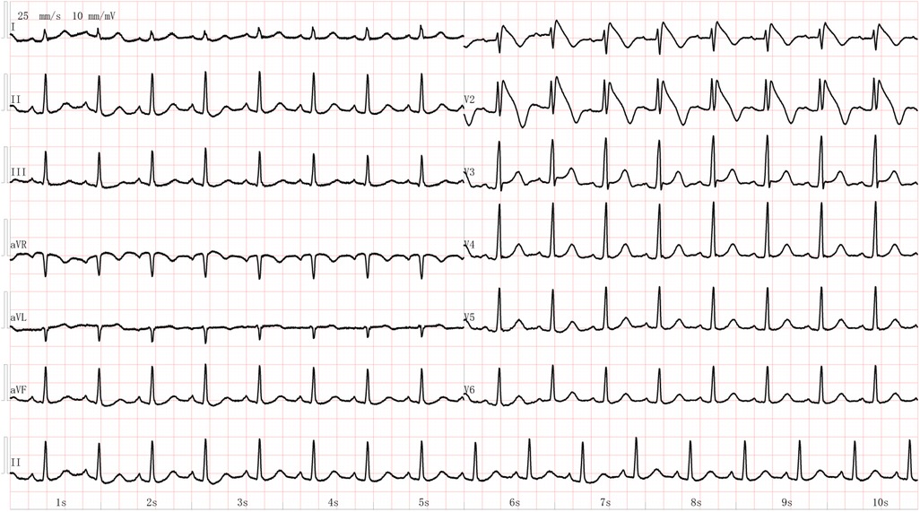 Electrocardiogram (ECG) showing multiple leads (I, II, III, aVR, aVL, aVF, V1-V6) with sharp, repeated peaks. The graph displays consistent QRS complexes across a ten-second interval, indicating heart rhythm. Gridlines mark time and voltage.