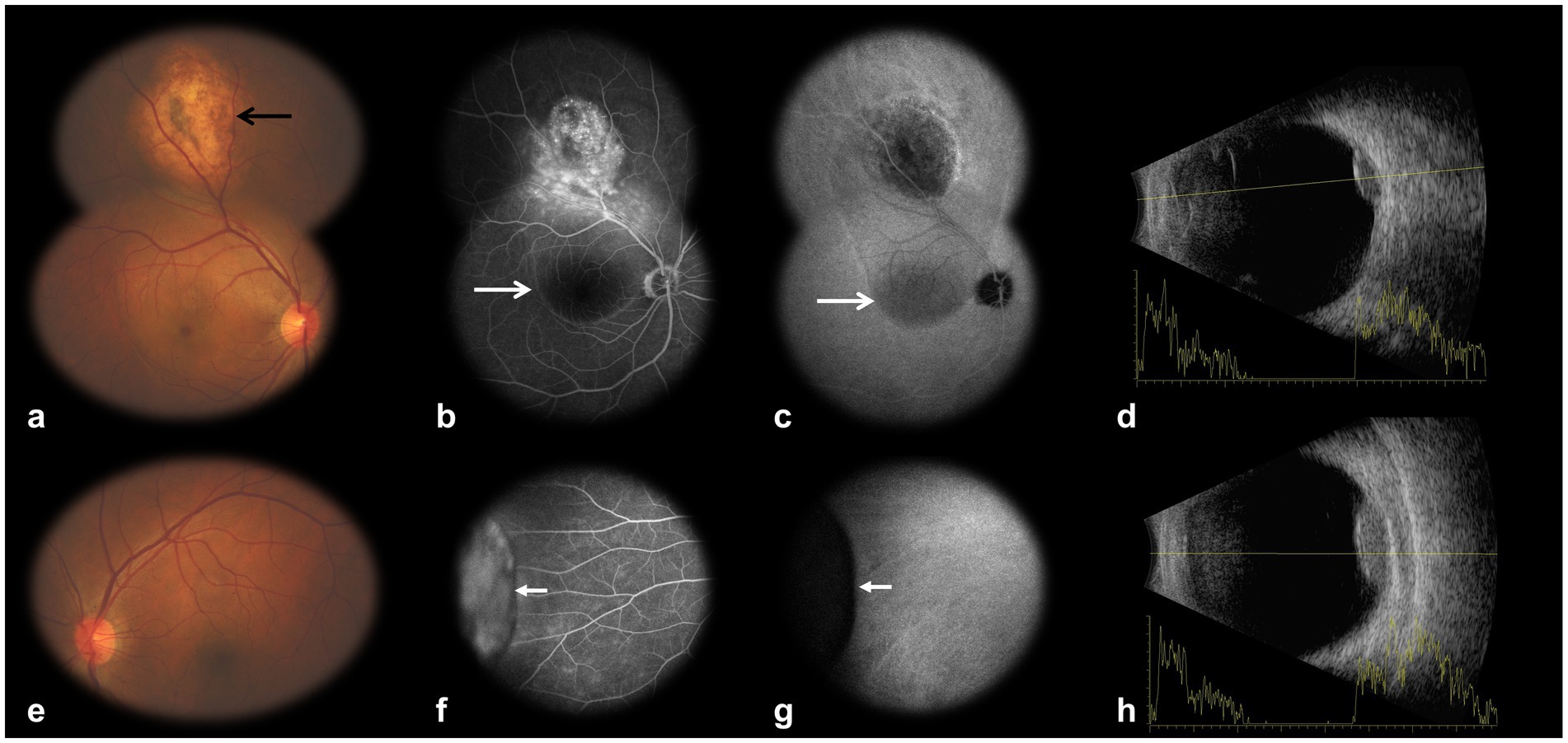 A series of medical images depicting eye diagnostics. Panel (a) shows a color fundus image with a lesion indicated by an arrow. Panels (b) and (f) are fluorescein angiography images highlighting areas of interest with arrows, namely the tumor and associated subretinal fluid. Panels (c) and (g) are indocyanine green angiography images, also with arrows indicating areas of interest. Panels (d) and (h) display B-scan ultrasonography with accompanying graphs showing retinal cross-sections and spikes. Panel (e) shows a color fundus image without a visible lesion.