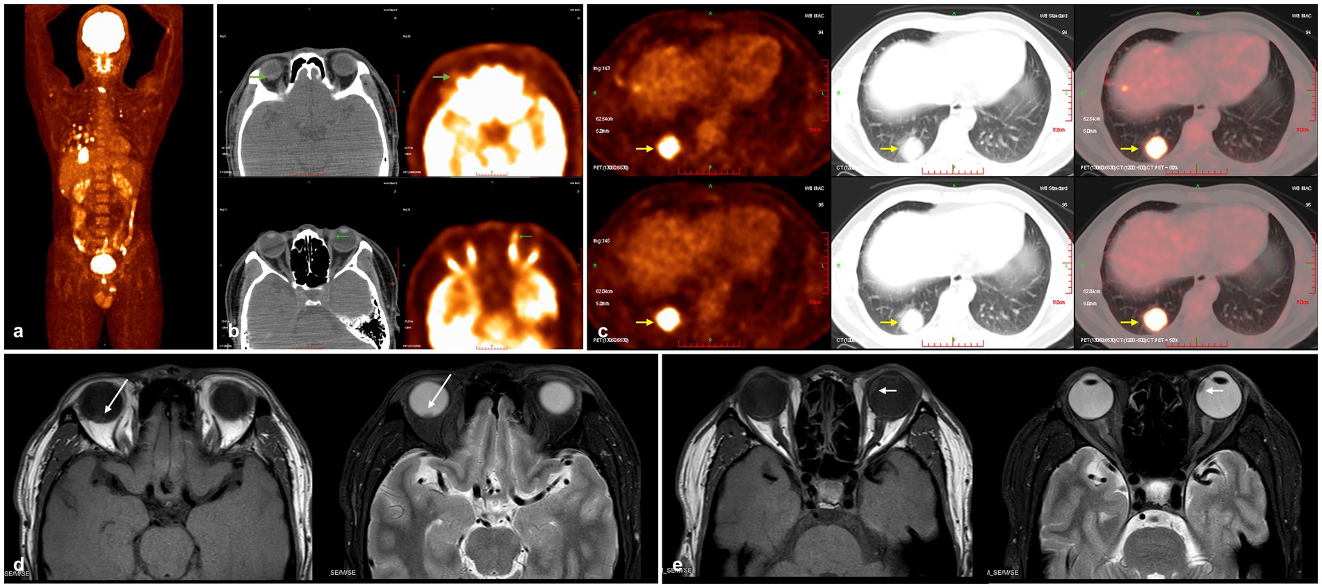 A series of medical imaging scans including PET, CT, and MRI. Image (a) shows a full-body PET scan with highlighted areas. Image (b) presents axial CT views of the skull. Image (c) displays axial PET-CT fusion scans of the chest, with increased uptake marked by arrows. Images (d) and (e) feature axial MRI scans of the brain, with arrows indicating specific areas of interest in the eyes.