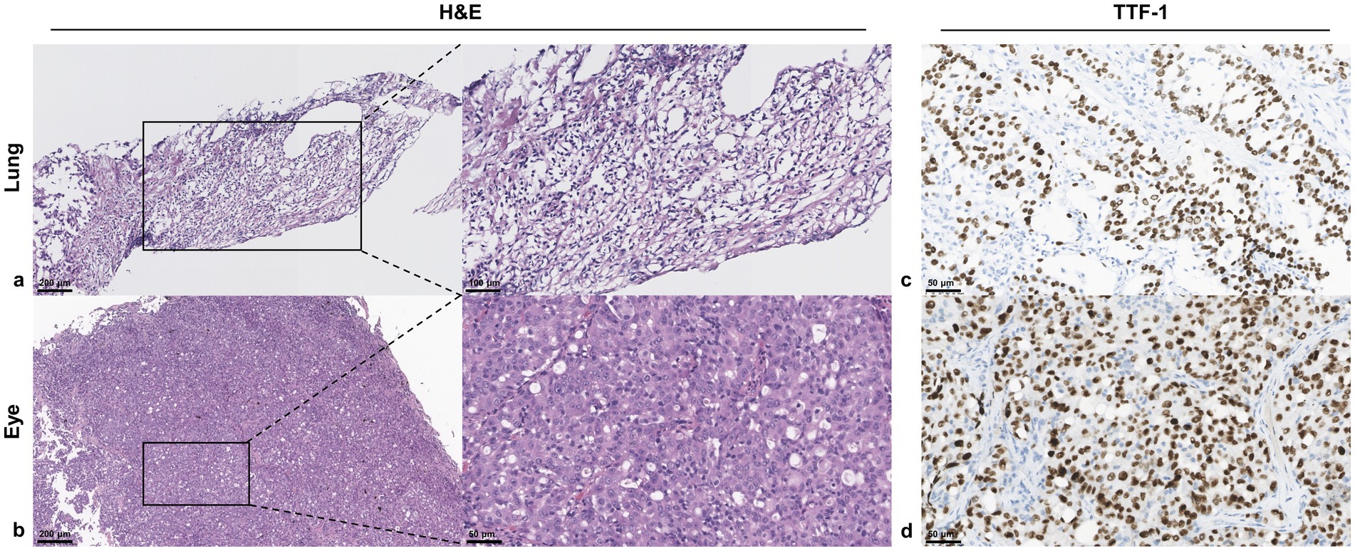 Histology images show tissue sections from the lung and eye under H&E and TTF-1 staining. Panels a and b present H&E-stained sections with detailed insets, revealing cellular structures. Panels c and d show TTF-1 stained sections with dark-stained nuclei on a lighter background, indicating specific protein expression. Scale bars are included for reference.