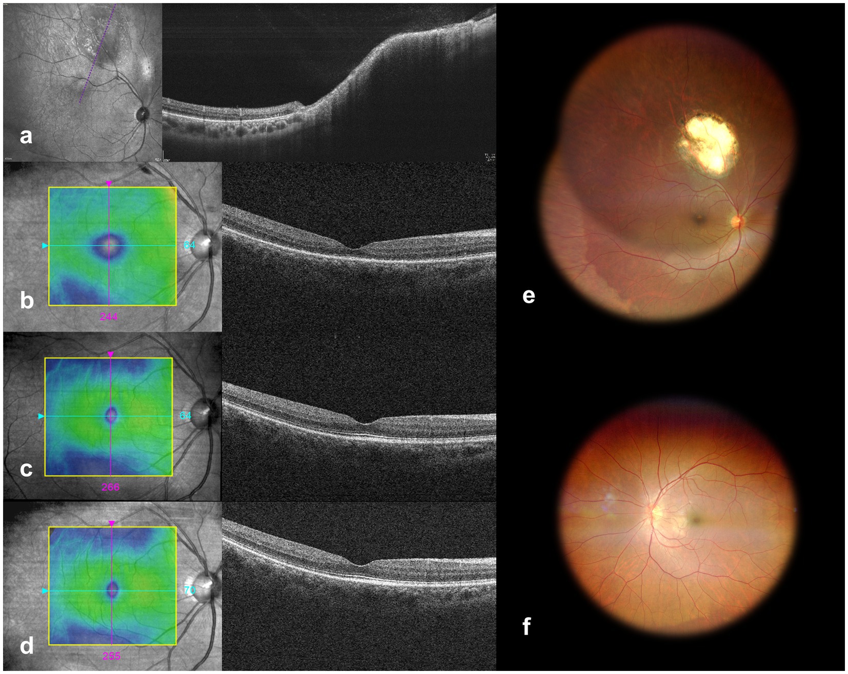 OCT and fundus images show retinal structure and lesions. Panels a to d display OCT scans with color-coded maps indicating thickness. Panel e shows a fundus image with a bright lesion, while panel f shows a normal retinal appearance without lesions.