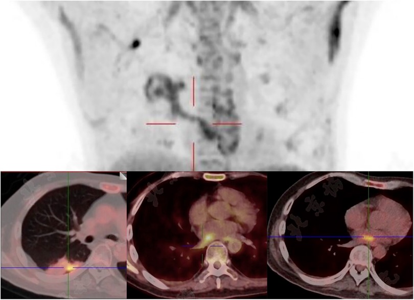 Composite medical image including grayscale and colorized scans, showing cross-sectional views of the thorax. Red crosshairs indicate areas of focus, possibly highlighting abnormalities or areas of interest within the chest cavity.