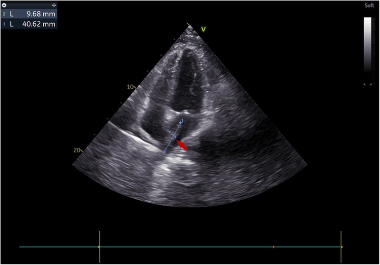 Ultrasound image displaying a cross-sectional view of a heart. A red arrow and blue measurement line highlight a specific structure, with dimensions noted as 9.68 millimeters and 40.62 millimeters. The grayscale color map is visible on the side.