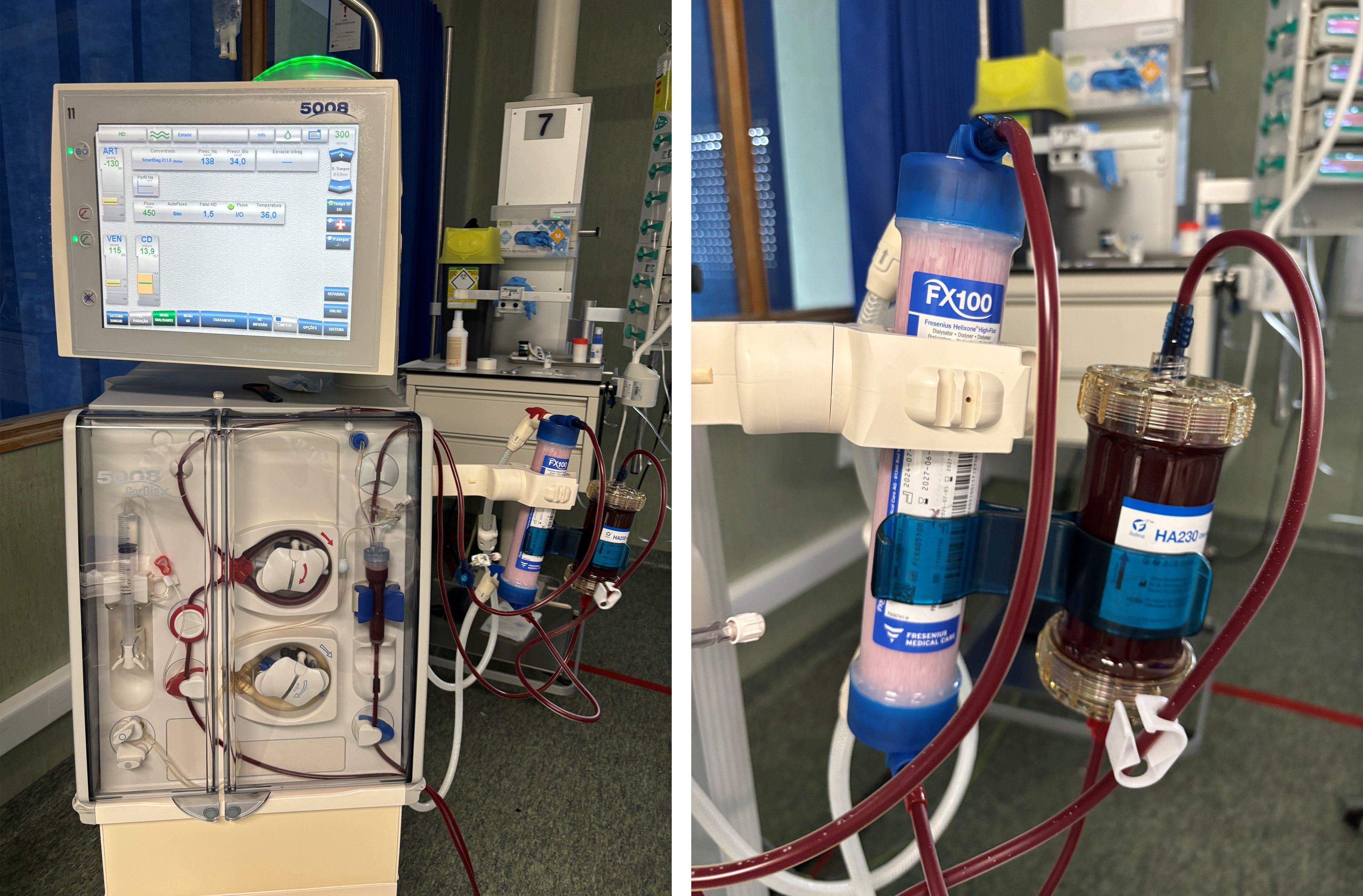 A dialysis machine in a clinical setting. The left image shows the extracorporeal circuit setup using the Fresenius 5008® system. The right image is a close-up of the FX100 dialyzer and the HA230 hemoadsorption cartridge placed post-filter in the circuit.