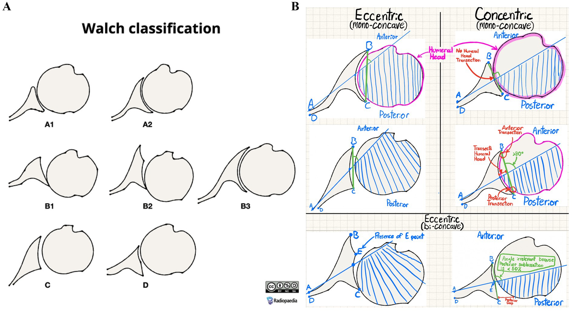 Diagram illustrating the Walch classification of shoulder joint morphology. Part A shows different shapes of glenoid wear patterns labeled A1, A2, B1, B2, B3, C, and D. Part B provides detailed labeled diagrams comparing eccentric and concentric glenoid wear patterns, explaining mono-concave and bi-concave formations with annotations on anterior, posterior, and humeral head positions.