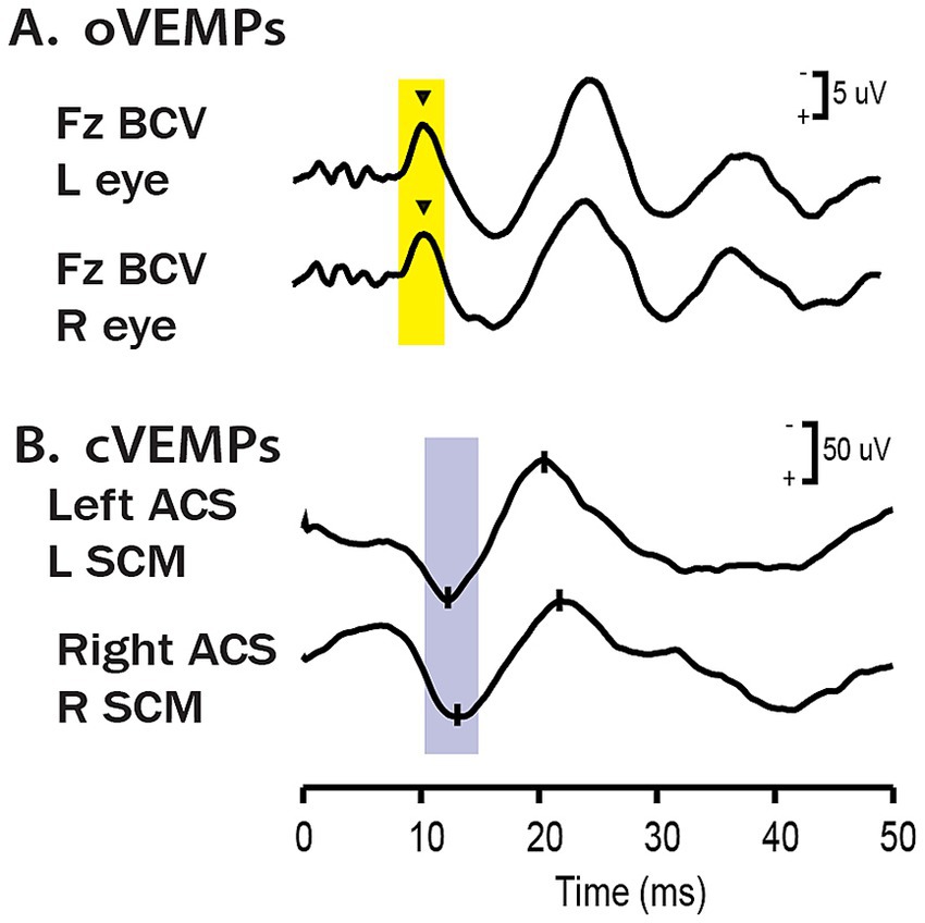 Graph showing oVEMPs and cVEMPs measurements. Section A displays oVEMPs with scalp-recorded responses from left and right eyes, marked by yellow highlights. Section B shows cVEMPs from left and right sternocleidomastoid muscles, highlighted in blue. Vertical markers indicate significant points. Horizontal axis represents time in milliseconds.
