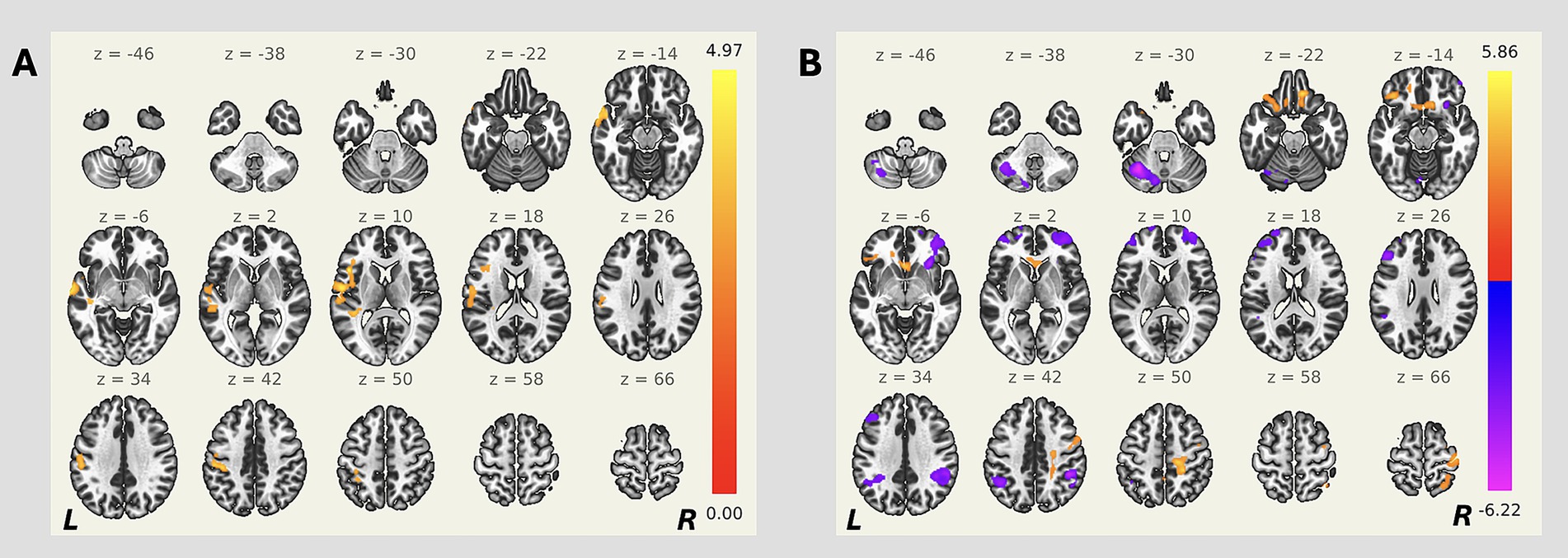 Two panels labeled A and B display brain imaging results with different z-slice levels ranging from z=-46 to z=66. Panel A highlights regions in shades of orange and yellow, while panel B shows areas in purple and orange. Both panels include a color scale on the right, with panel A ranging from 0 to 4.97 and panel B from -6.22 to 5.86.