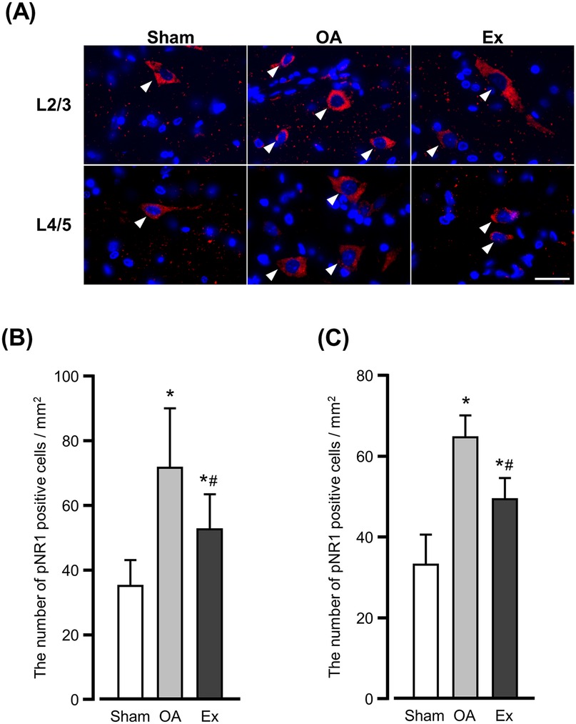 (A) Four fluorescence microscopy images show the expression of pNR1 in L2/3 and L4/5 the dorsal horn of the spinal cord under Sham, OA, and Ex conditions. Red staining indicates pNR1-positive cells, with blue marking cell nuclei. (B) and (C) Bar graphs display the number of pNR1 positive cells per square millimeter, showing higher counts in the OA and Ex groups compared to Sham, with significant differences marked by asterisks and hashtags.