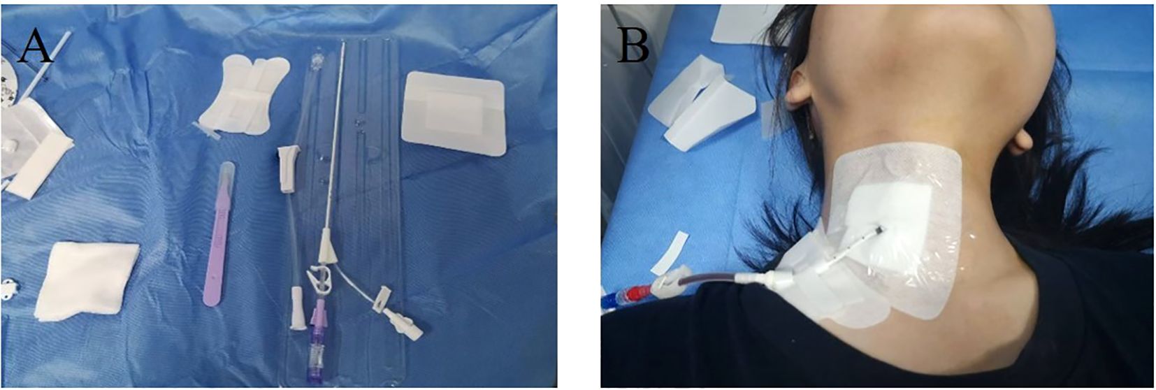 Panel A shows medical supplies on a blue surface, including a scalpel, catheter, and gauze. Panel B depicts a person with a catheter inserted in their neck, secured with transparent dressings.