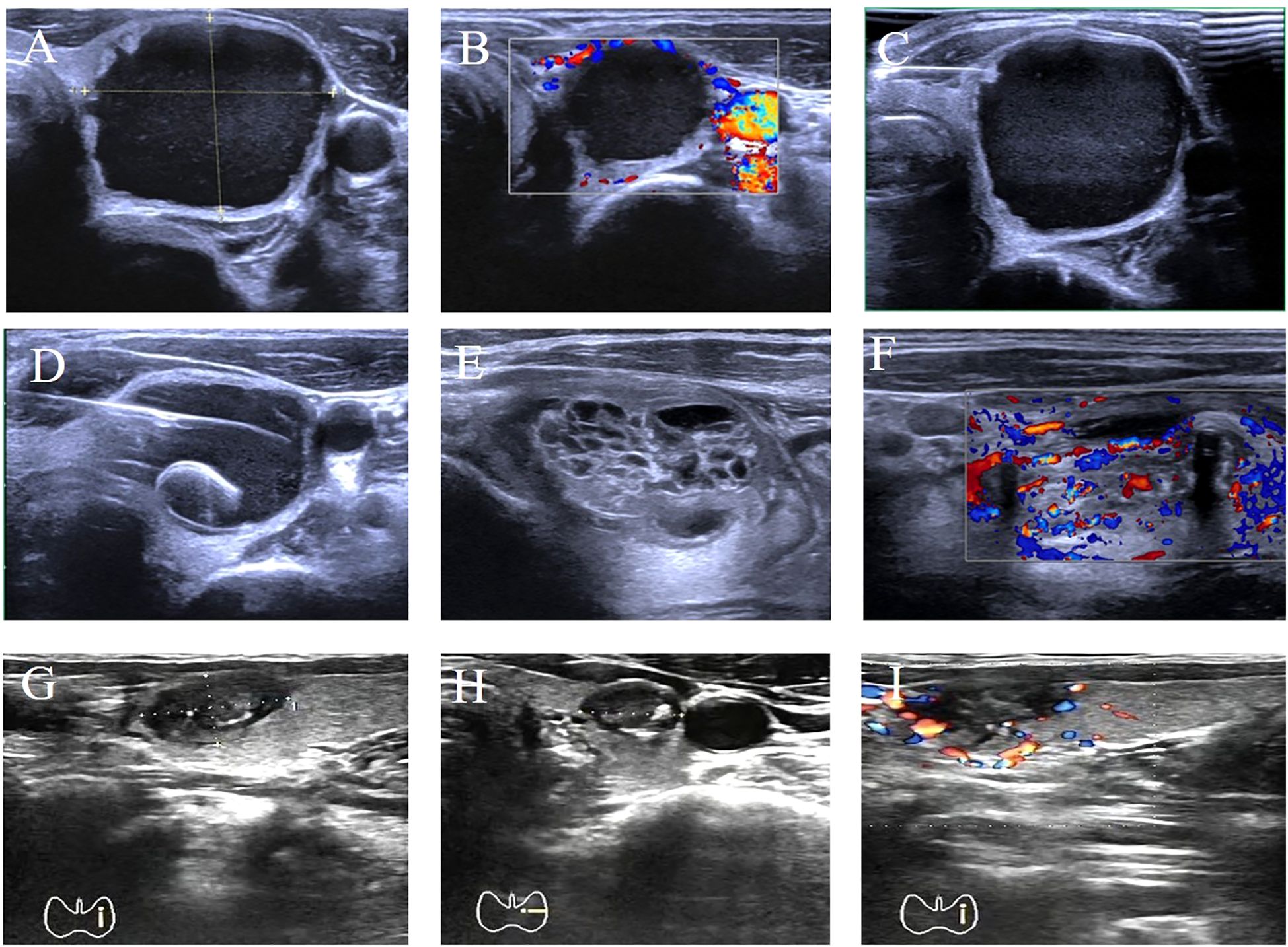 Nine ultrasound images labeled A to I. Images A, C, D, E, G, and H show different grayscale ultrasound scans of circular or oval structures. Images B, F, and I include Doppler color flow overlays with red and blue coloring indicating blood flow.