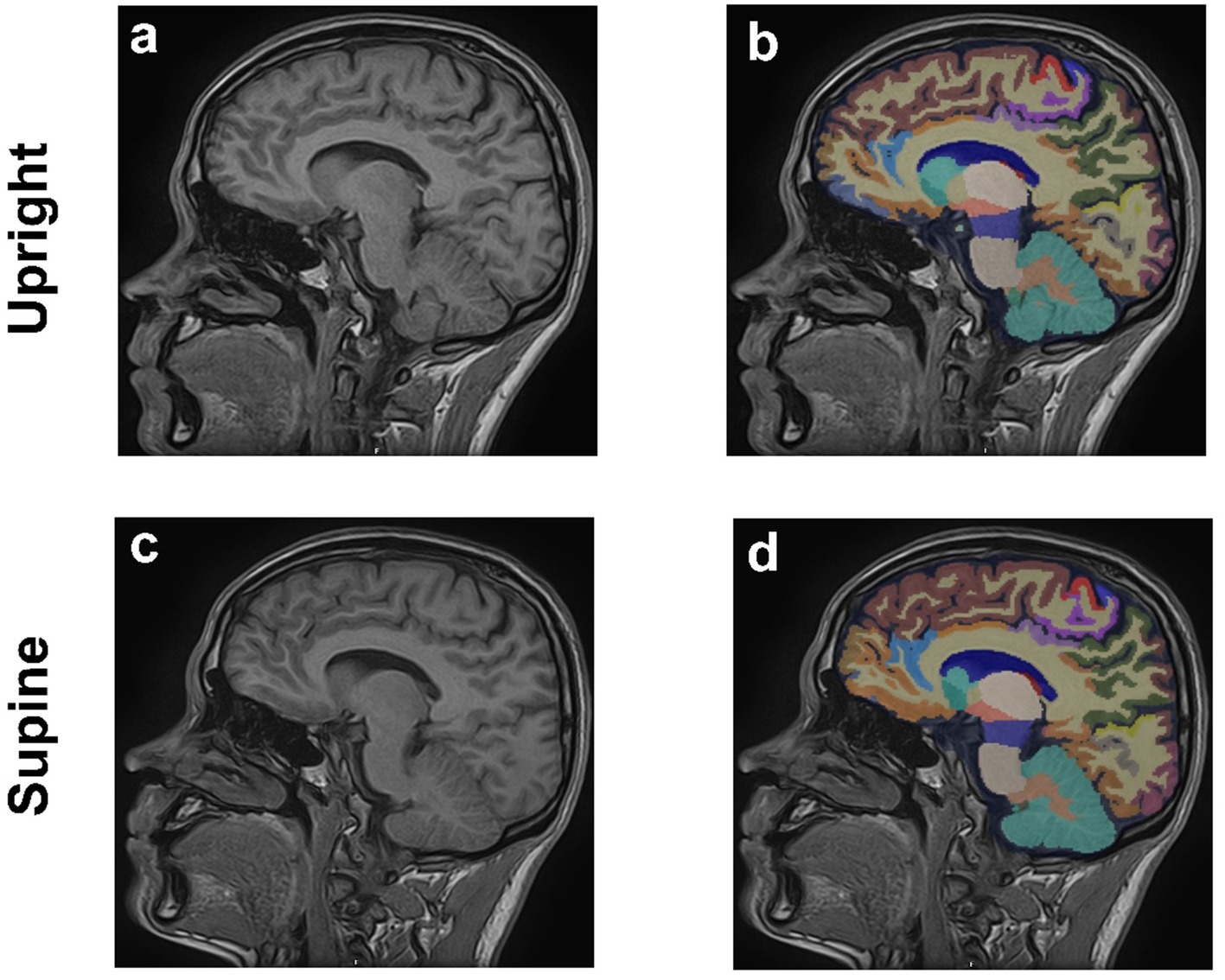 Four MRI brain scans in sagittal view. Panel a and c show grayscale images with the person upright and supine respectively. Panel b and d display colored overlays indicating different brain regions, corresponding to the upright and supine positions of panels a and c.