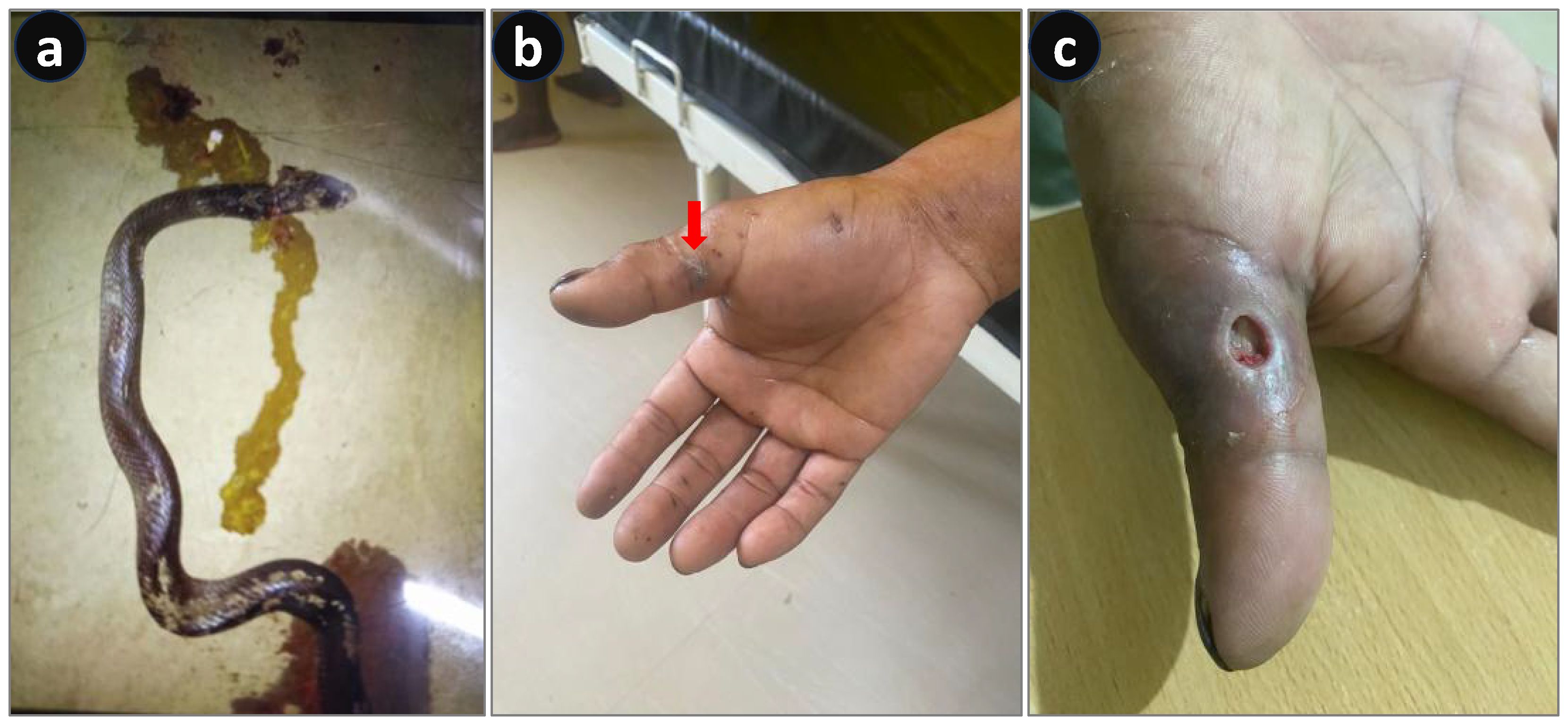 (a) A snake with a dark banded pattern on the floor. (b) A hand showing a bite mark with a red arrow pointing at it. (c) A close-up of a hand with a wound on the thumb, appearing swollen.