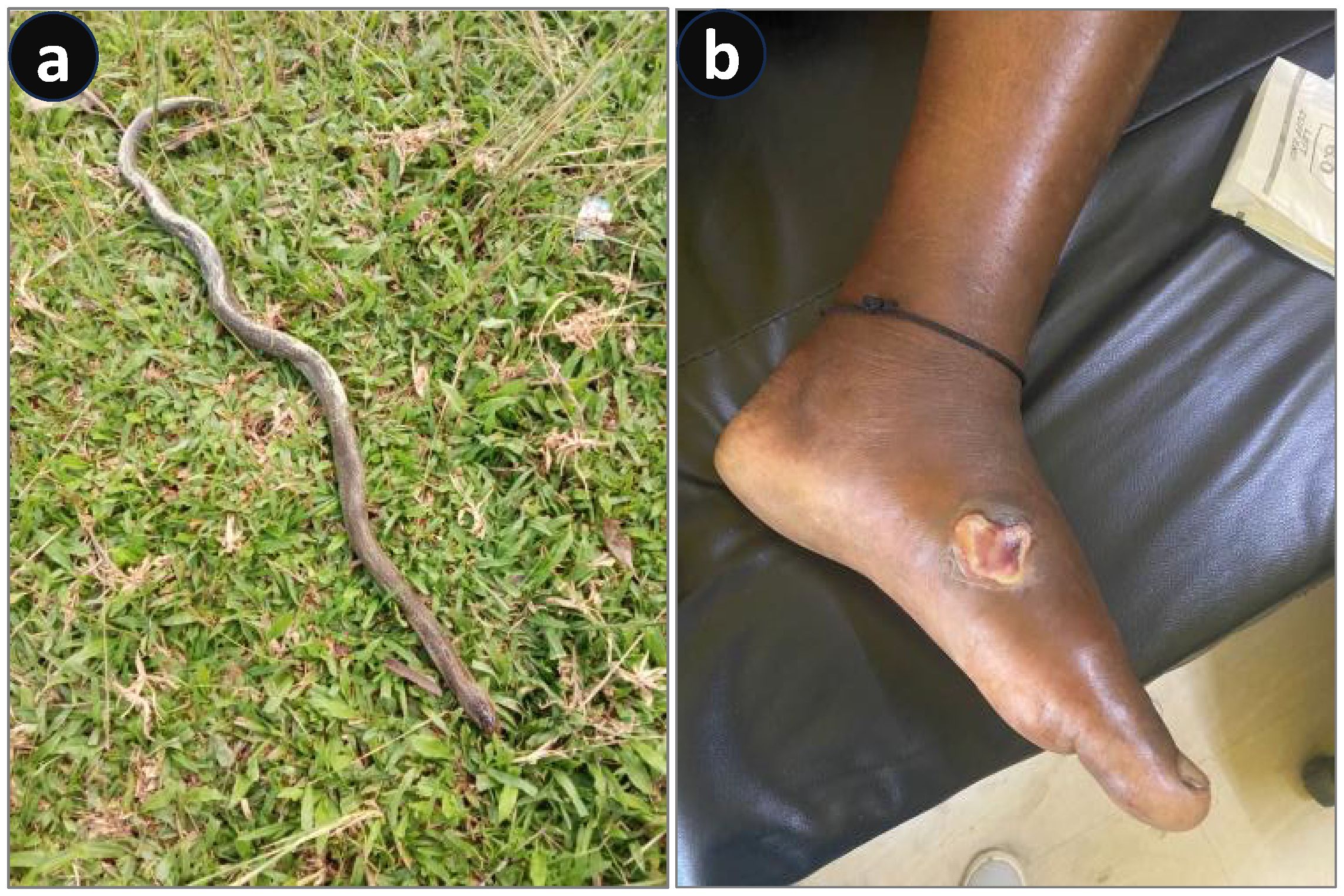 Panel a shows a snake on grass, with a long, slender body. Panel b depicts a human foot with a visible ulcerated wound on the top, resting on a black surface.