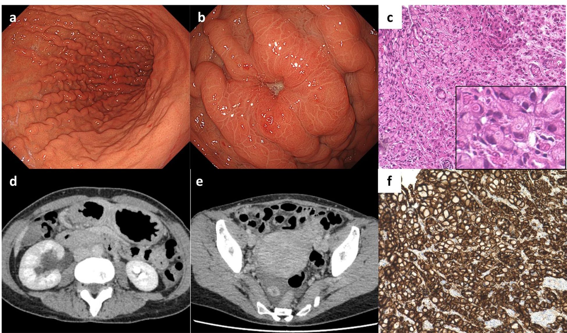 Six medical imaging panels showing different views of the abdomen: a) Endoscopic view of the gastric lining with folds. b) Enlarged gastric folds with visible irritation. c) Histological section showing cell detail with inset. d) CT scan of the abdomen displaying soft tissue and organ structures. e) Lower abdominal CT scan illustrating pelvic area. f) Histological section with brown-stained cells.