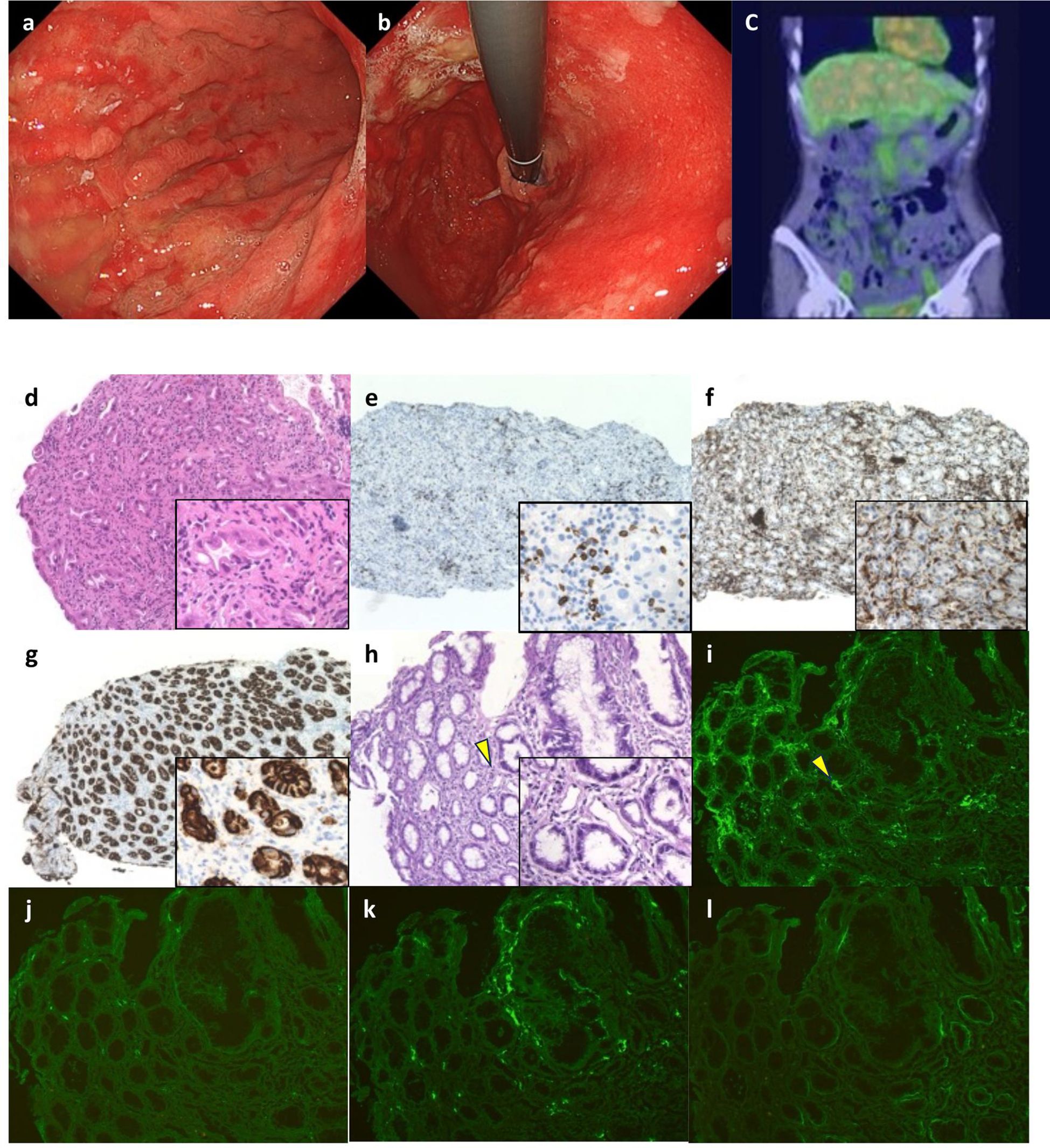 Composite image with multiple panels: a) An endoscopic view showing inflamed gastric tissue. b) An endoscopic procedure being performed. c) A scan highlighting areas of interest in green. d-l) Various histological and fluorescent images showing tissue samples with different staining techniques, highlighting cellular structures and patterns. Each has an inset for detailed examination.